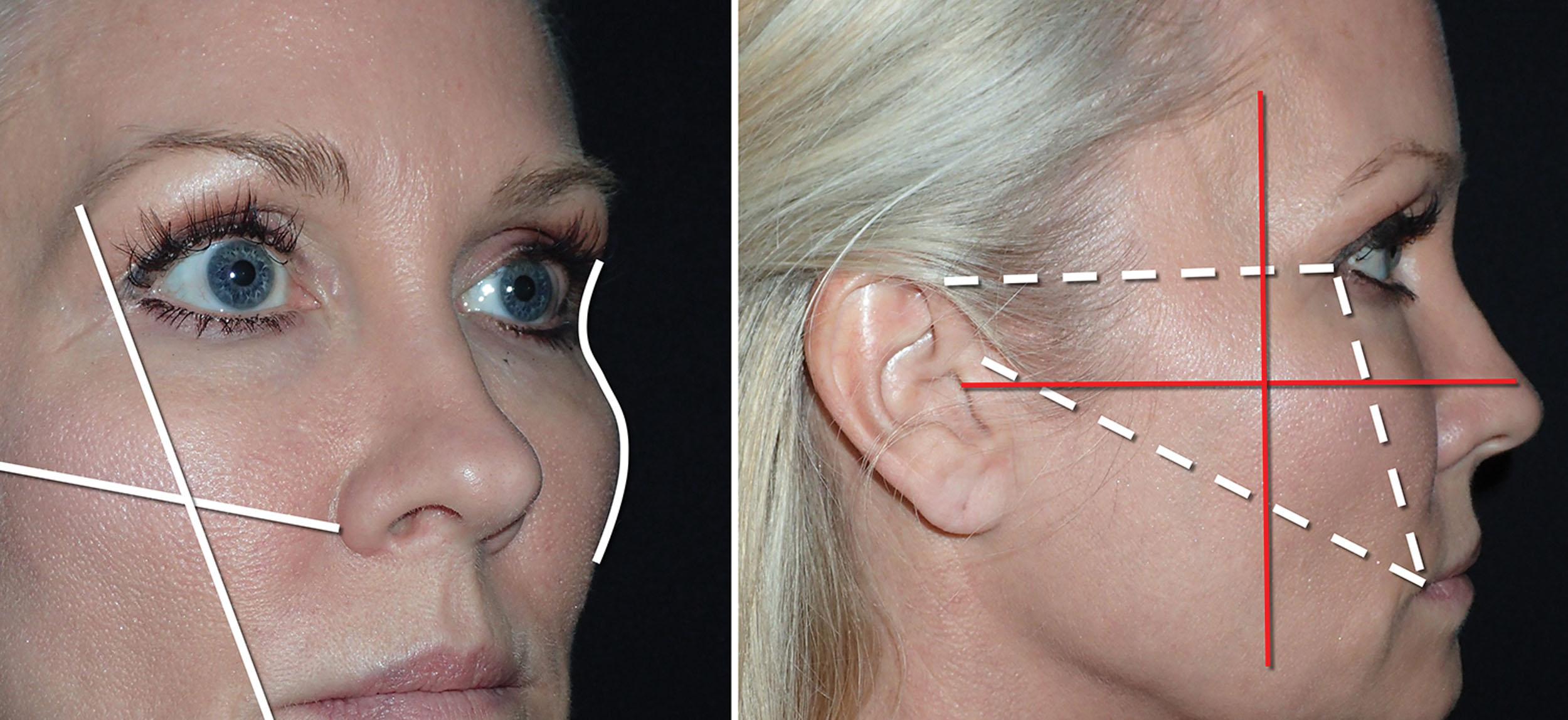 Fig. 10.84, Hinderer’s lines and the ogee curve define the youthful, volumized cheek (left). Vertical and horizontal lines (red lines) intersecting within a triangle from the canthus to the commissure and helical attachment also represent the region of desired filler augmentation (right) .