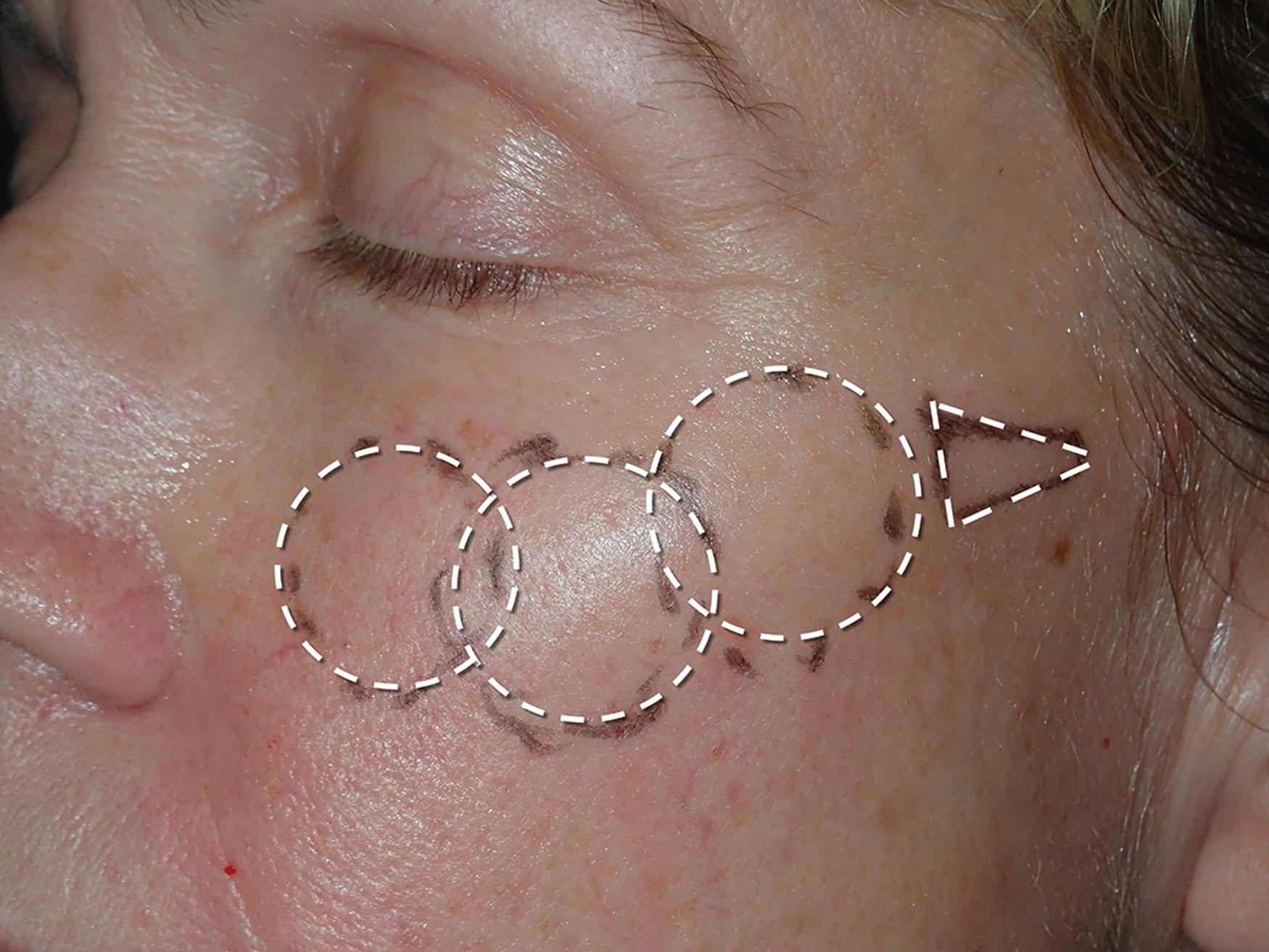 Fig. 10.85, The olympic ring technique I describe is marked with contiguous circles over the infraorbital, malar, and zygomatic regions of the midface and a final tail over the zygomatic arch.