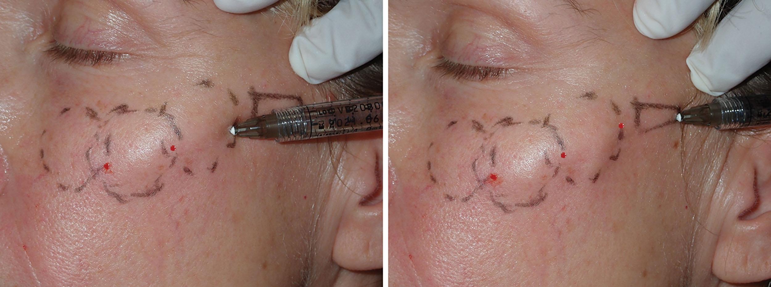 Fig. 10.87, The zygomatic circle injection (left) and the final zygomatic arch tail injection (right) .