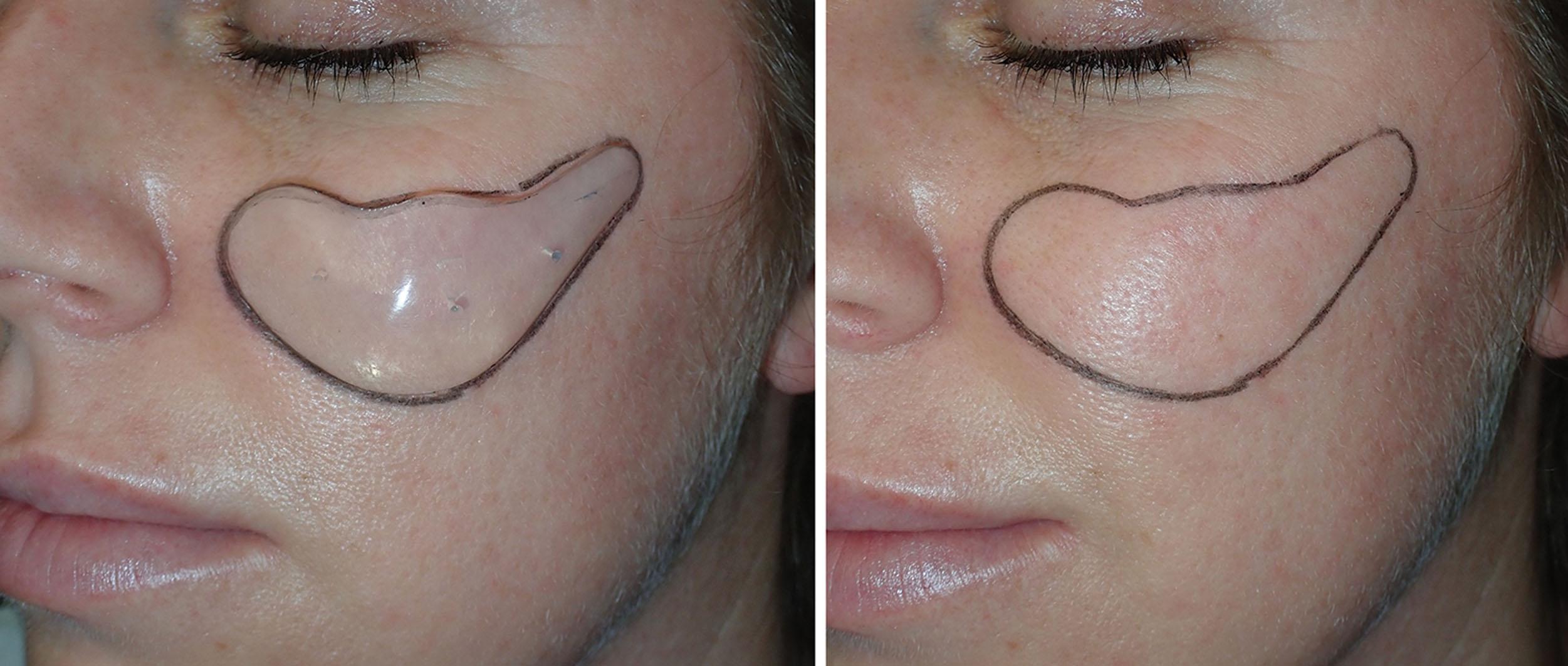 Fig. 10.90, A tracing around a cheek implant provides an accurate template for midface filler injection. This pattern highlights all of the major regions of midface volume.