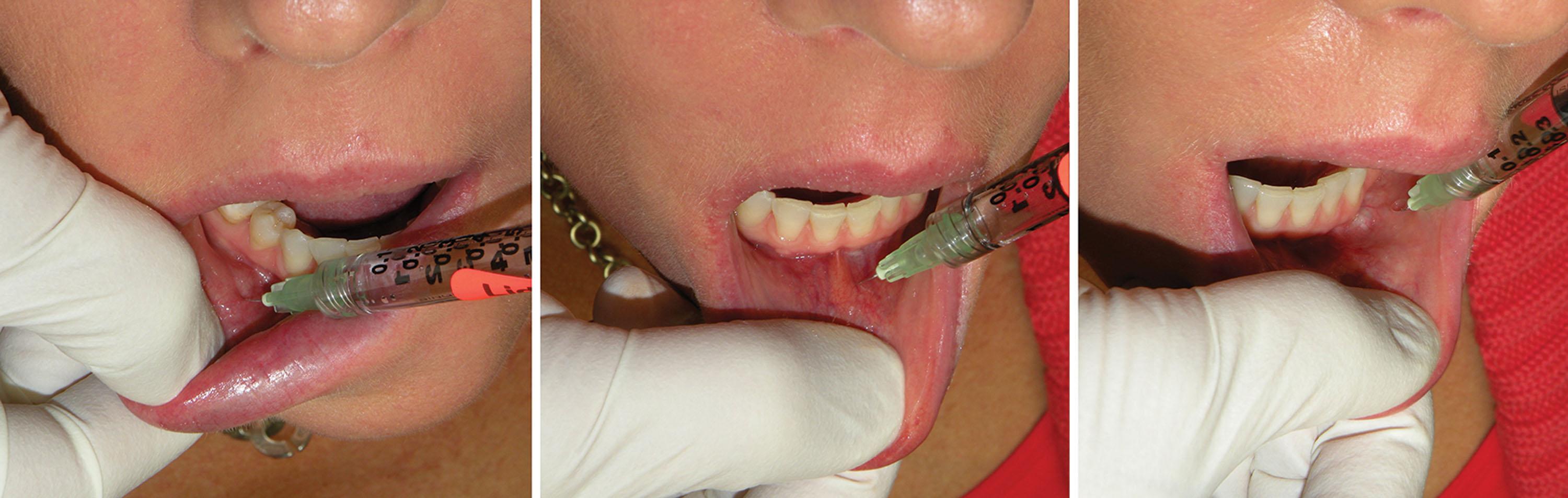 Fig. 10.9, The lower lip is similarly anesthetized by injecting the same amount of the same solution just inferior to the sulcus.