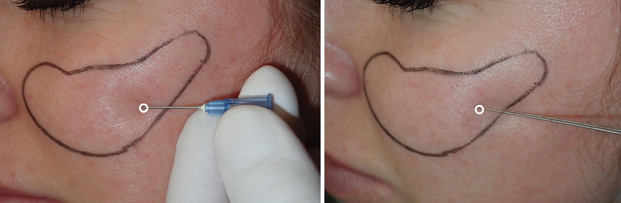 Fig. 10.91, Cannula injection in this region is the same as in other areas with a pilot puncture made (left) and the cannula inserted through that puncture (right) .