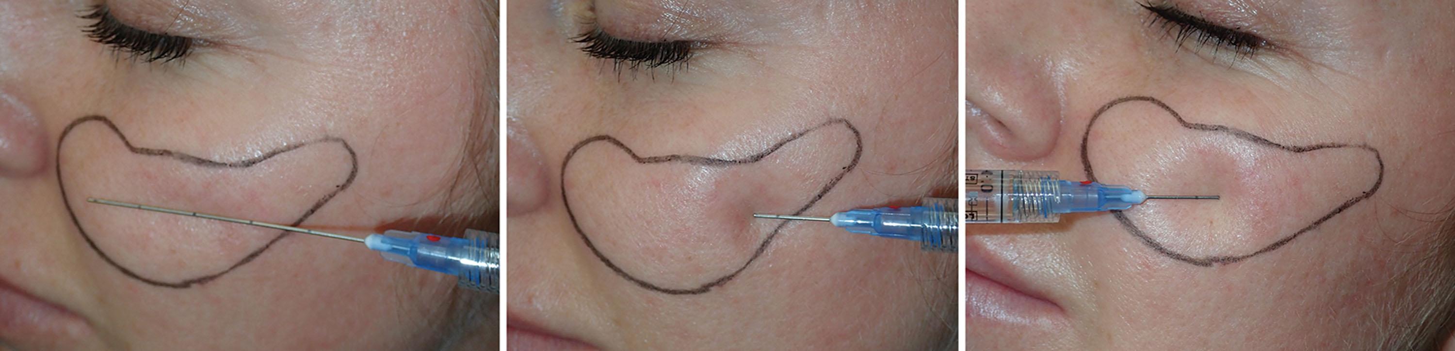 Fig. 10.92, The distance the cannula will be introduced in the subcutaneous plane is shown (left) . The cannula is retracted with simultaneous retrograde injection (center) and then introduced in the opposite direction through the original puncture (right) to fill the lateral zygomatic region.