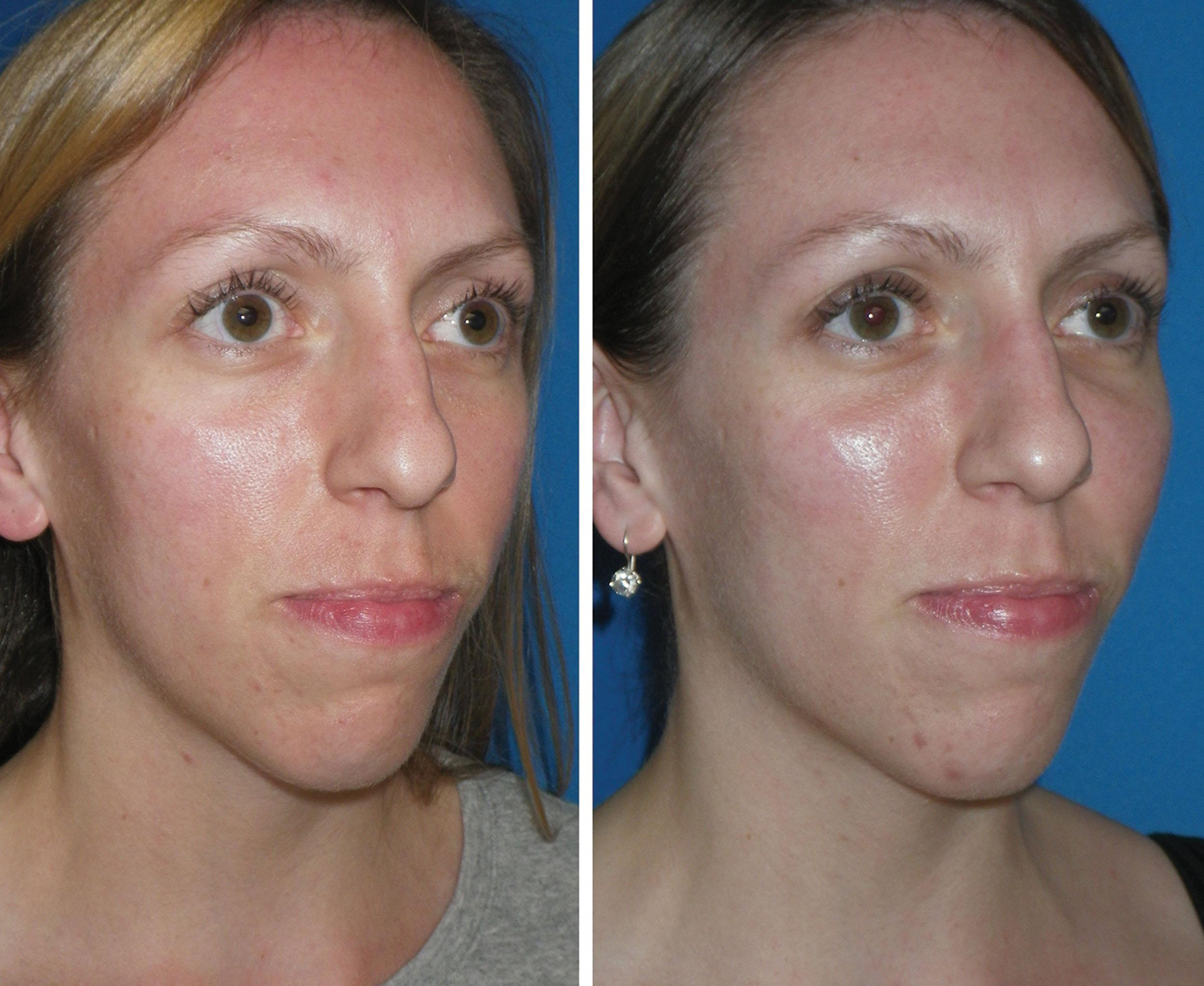 Fig. 10.95, This patient was treated with 1 mL of hyaluronic acid filler in each cheek. Note the light reflex in the before (left) and after (right) photos and the fullness of both cheeks compared with the before photo.