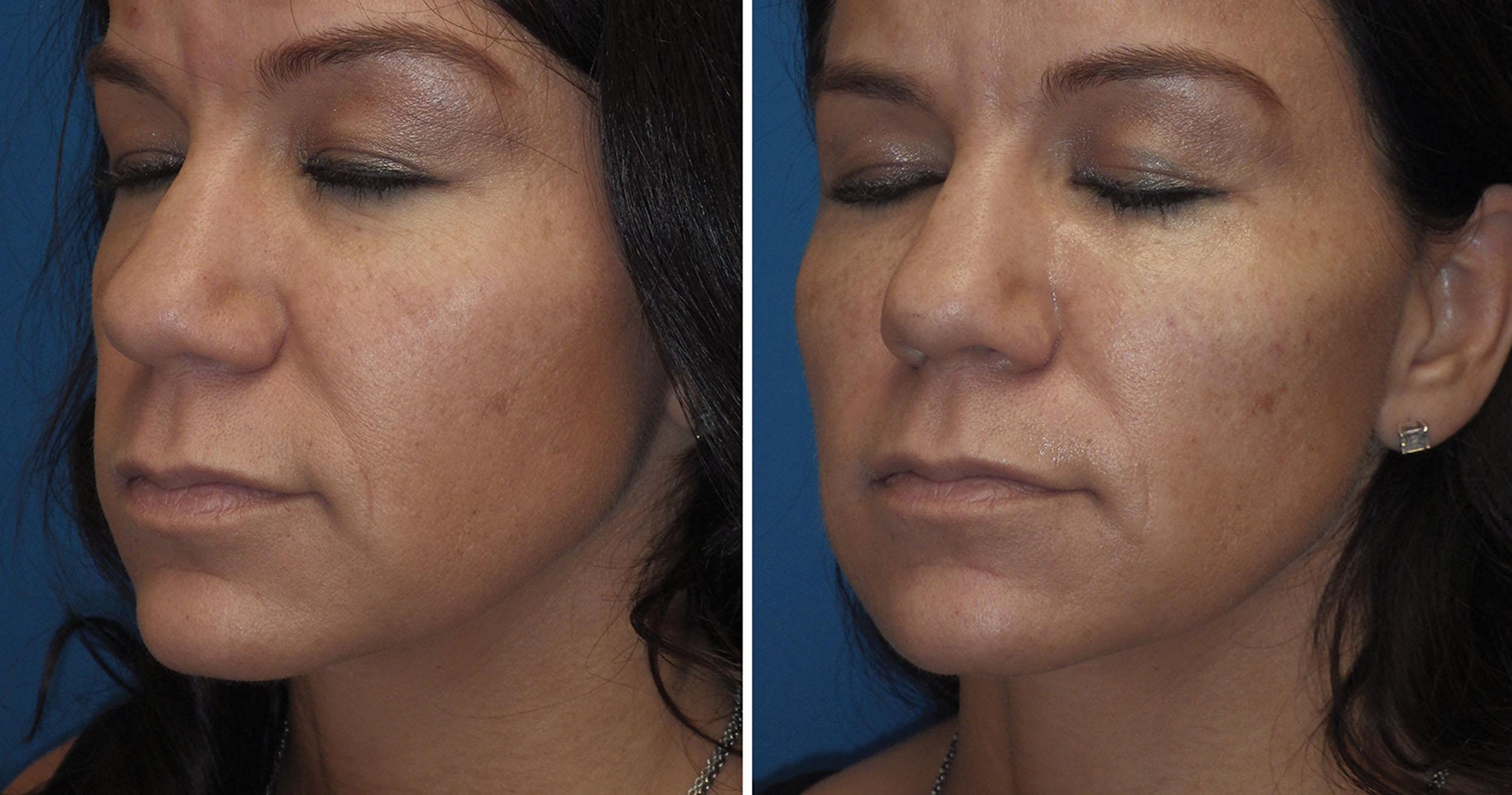 Fig. 10.96, This patient was treated with 1 mL of hyaluronic acid filler in each cheek.