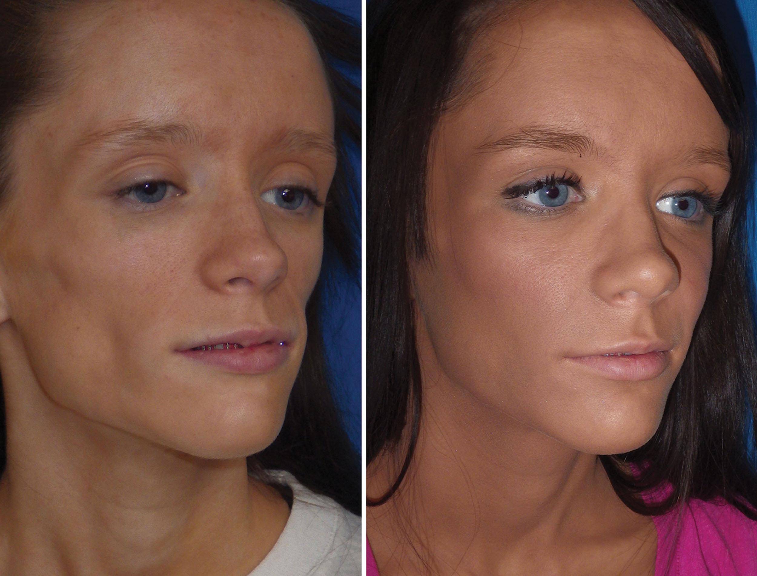 Fig. 10.97, This patient had a facial wasting syndrome and was treated with cheek implants, which helped but did not fulfill the augmentation. She was also treated with numerous sessions of Silikon 1000 injections. This combination of implant and permanent filler injection completed the rejuvenation.