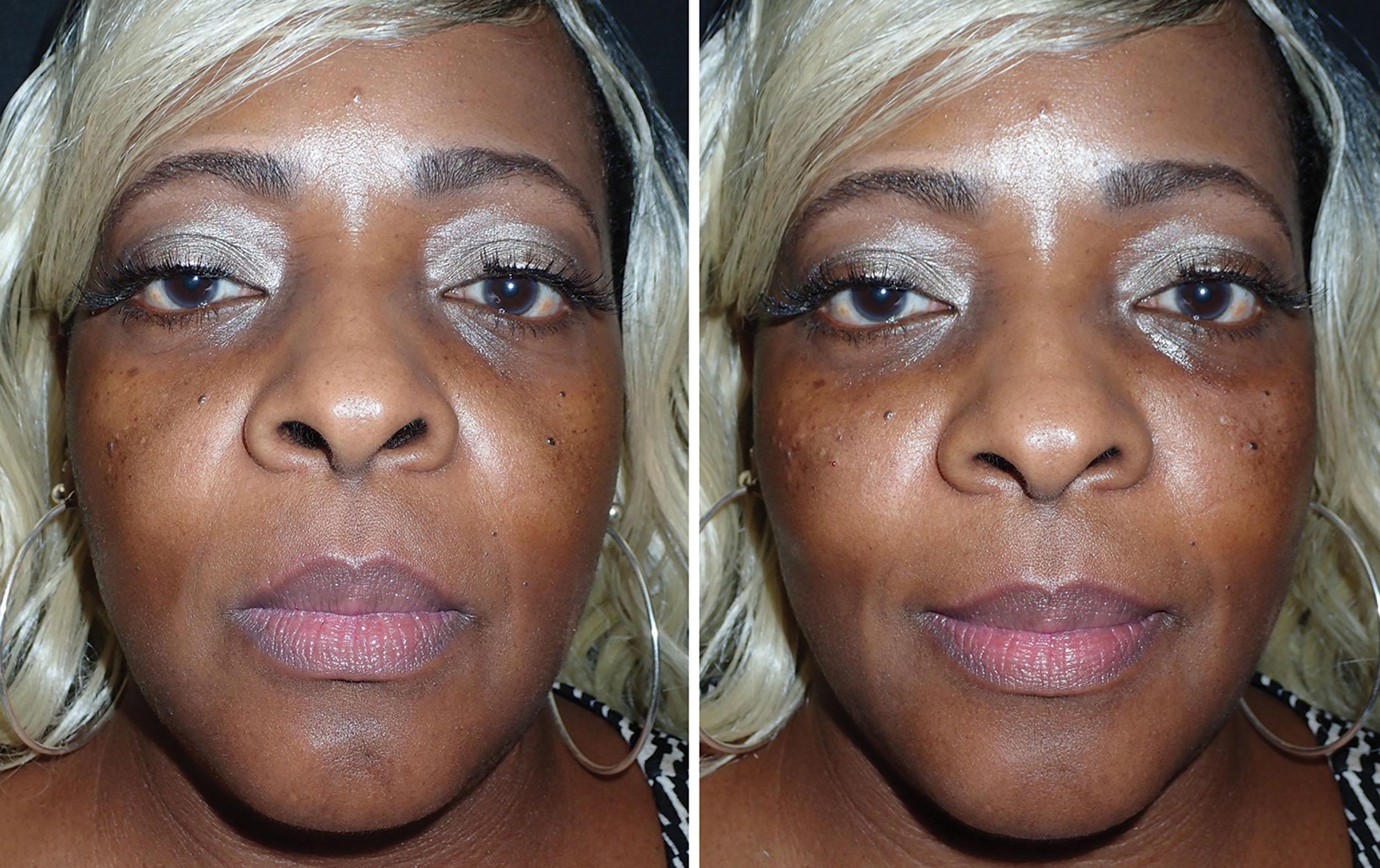 Fig. 10.98, This patient was treated with 2 mL of high G prime hyaluronic acid filler injected with a blunt, flexible cannula. She is shown before (left) and 20 minutes after (right) . This can be done very atraumatically with cannulas, and I have treated patients on their lunch hour.