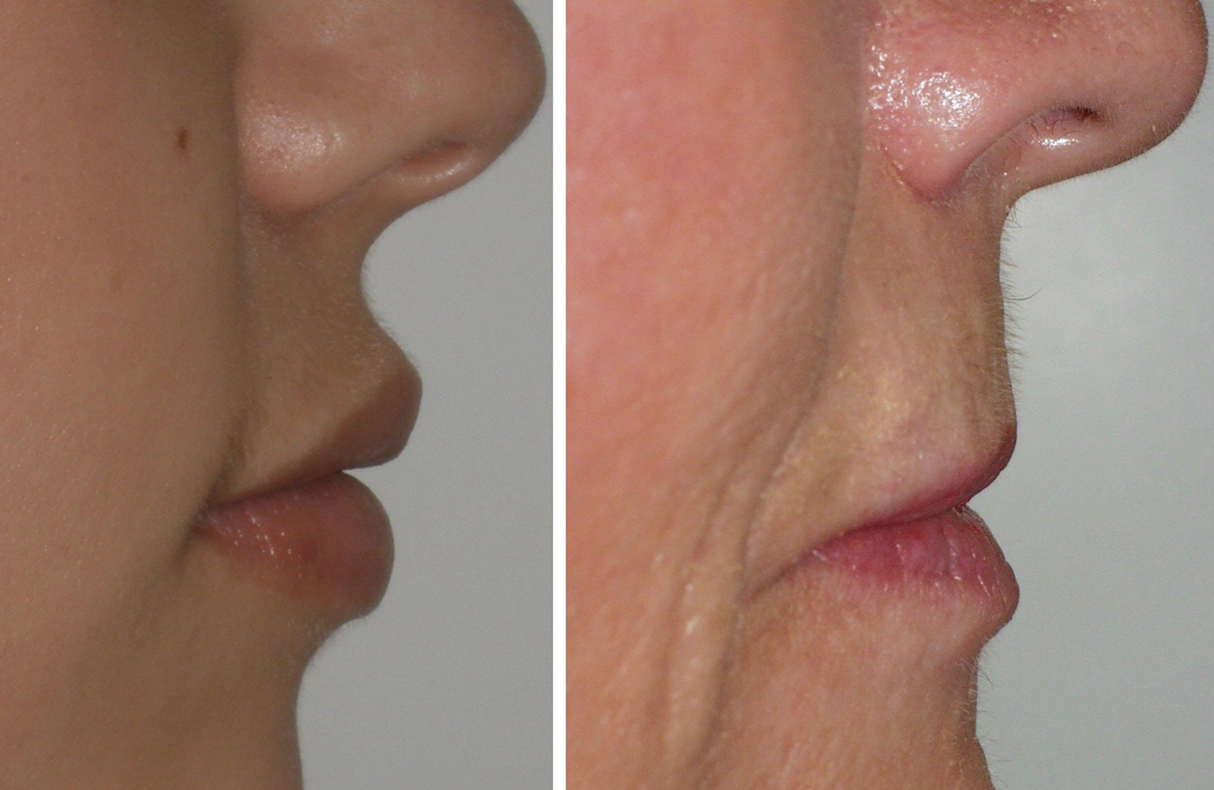 Fig. 10.10, The curvaceous and volumized aspect ratio of a youthful lip (left) and a senescent lip with loss of volume fullness texture and structure (right) are shown. Augmenting a youthful lip is much easier and is the best procedure for novice injectors. Treating the aging lip is an art form in and of itself as many female patients want better-looking lips but not “bigger” lips.
