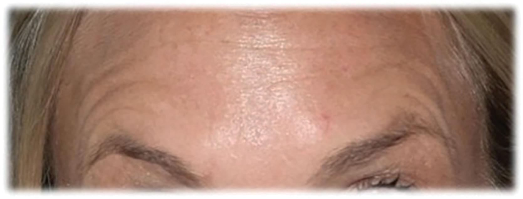 Figure 8.3.3, Exaggerated lateral brow peaking when treating the glabellar complex without treating the frontalis.