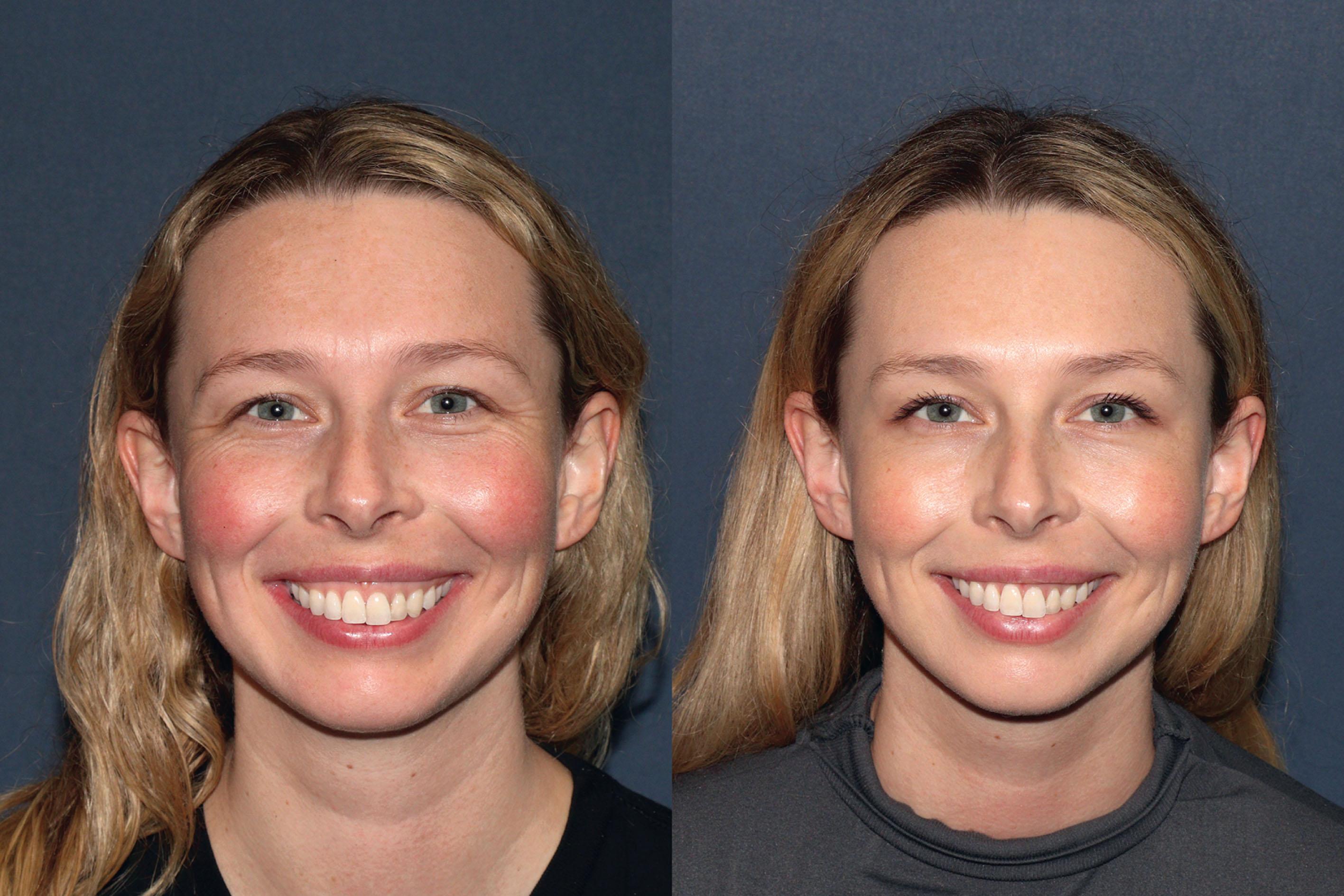 Figure 8.3.5, A 30-year-old female before and after 10 U of onabotulinumtoxinA to each orbicularis oculi.