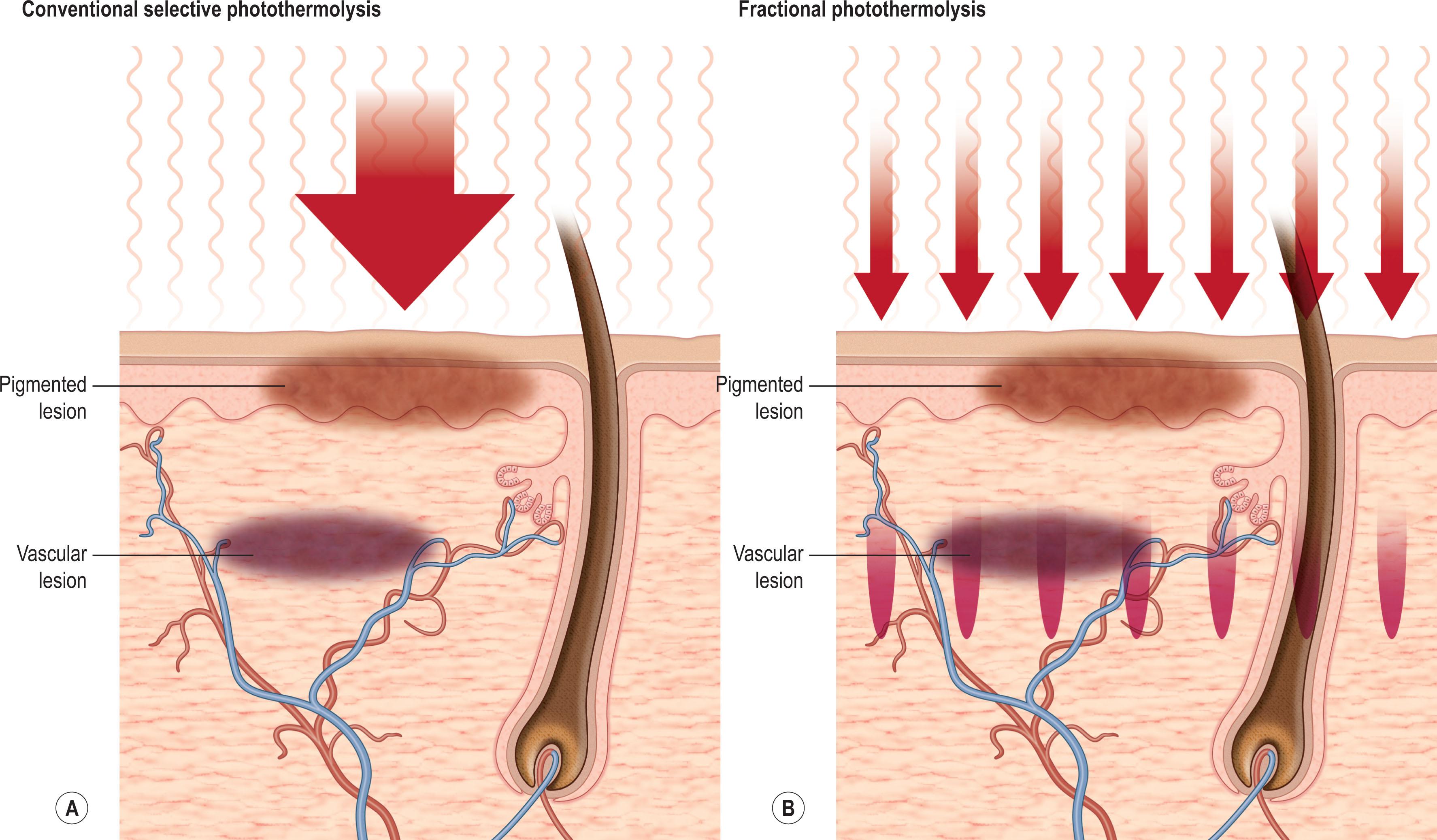 Figure 8.4.1, Conventional (A) versus fractional (B) photothermolysis.