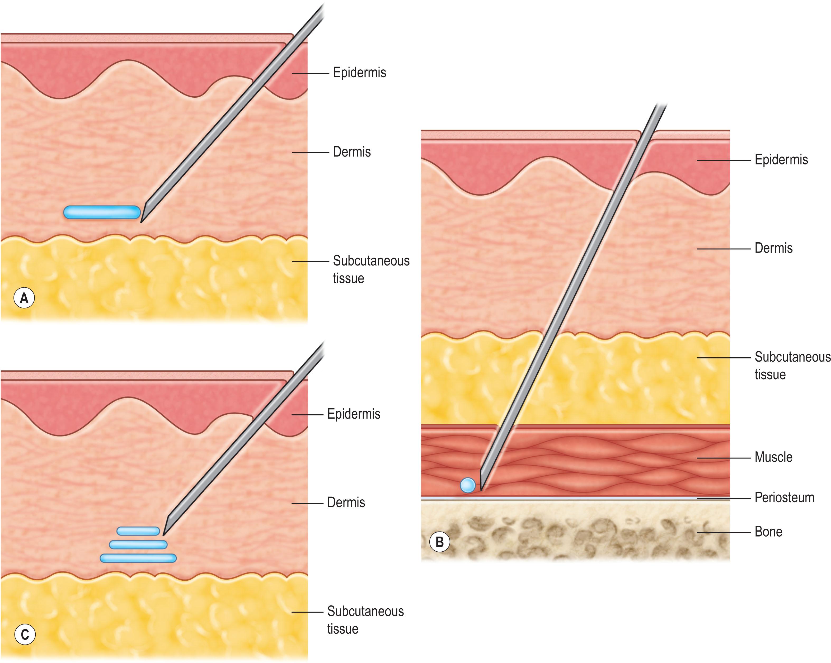 Figure 8.2.2, The (A) linear threading or tunneling, (B) droplet or depot, and (C) parallel linear threading techniques for dermal filler injection.