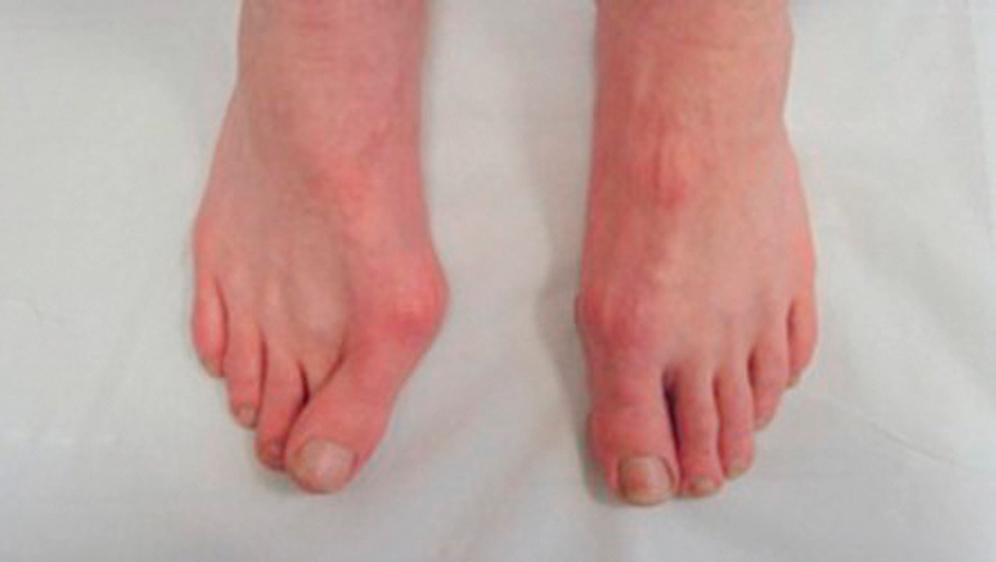 FIG. 193.1, The term bunion refers to a constellation of symptoms including soft-tissue swelling over the first metatarsophalangeal joint associated with abnormal angulation of the joint that results in a prominent first metatarsal head with associated overlapping of the first and second toes.