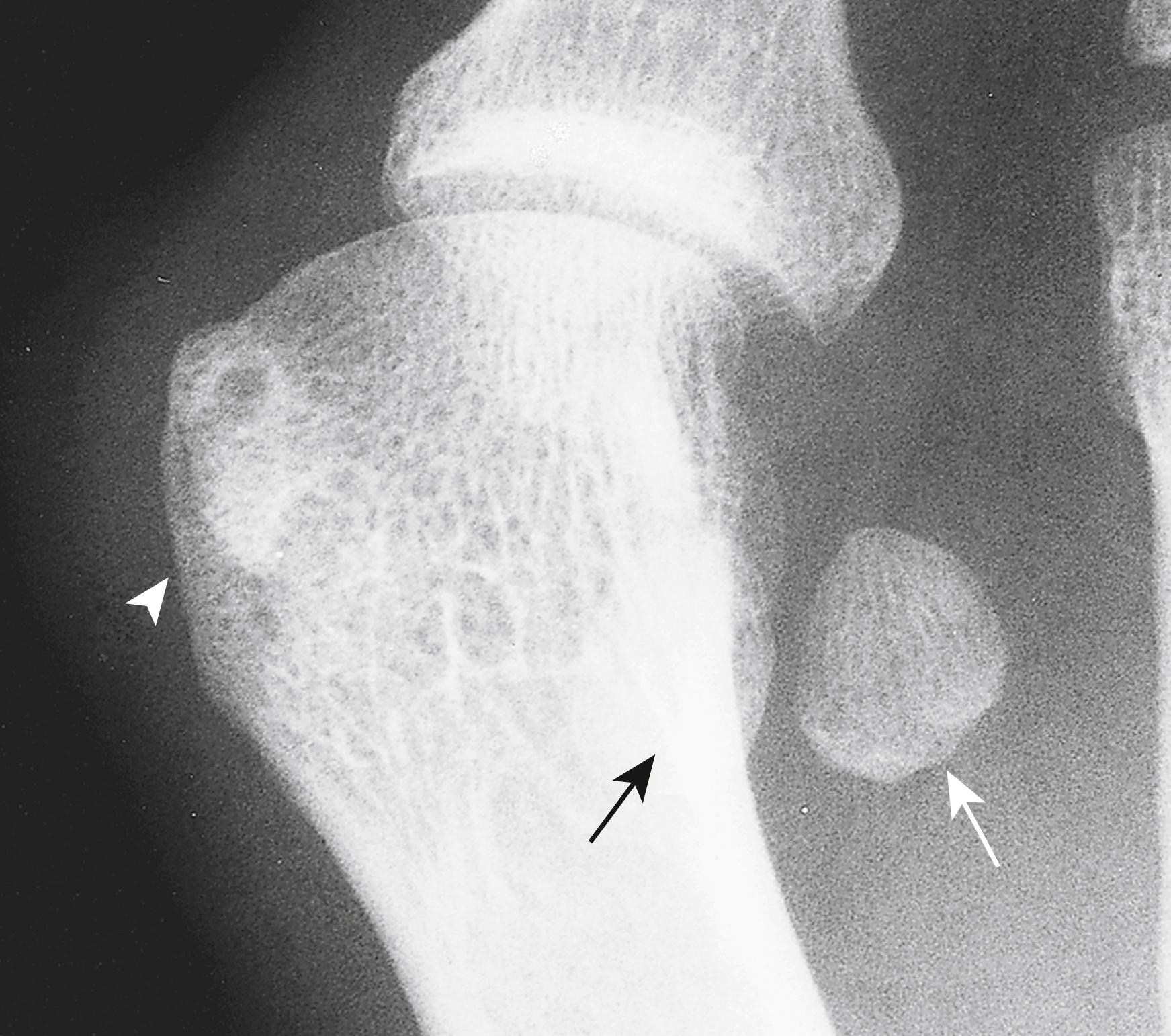 FIG. 193.2, Hallux valgus. Abnormalities consist of soft-tissue swelling, lateral displacement and rotation of the proximal phalanx and sesamoids (arrows) , and bony hypertrophy (arrowhead) on the medial aspect of the metatarsal bone.