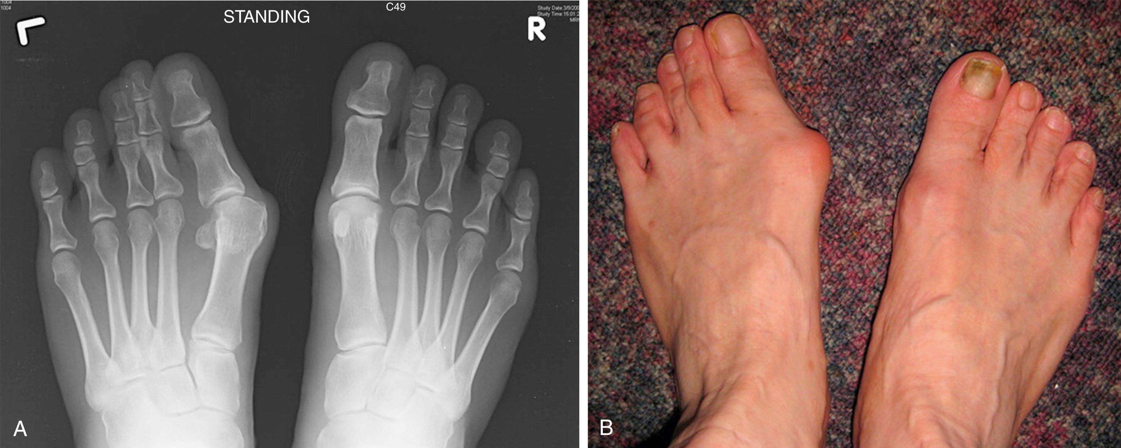 FIG. 193.3, A, Standing radiograph and (B) clinical photograph of one of the patients in the series showing left hallux valgus with inflamed adventitial bursa, left second claw toe, and bilateral bunionettes.