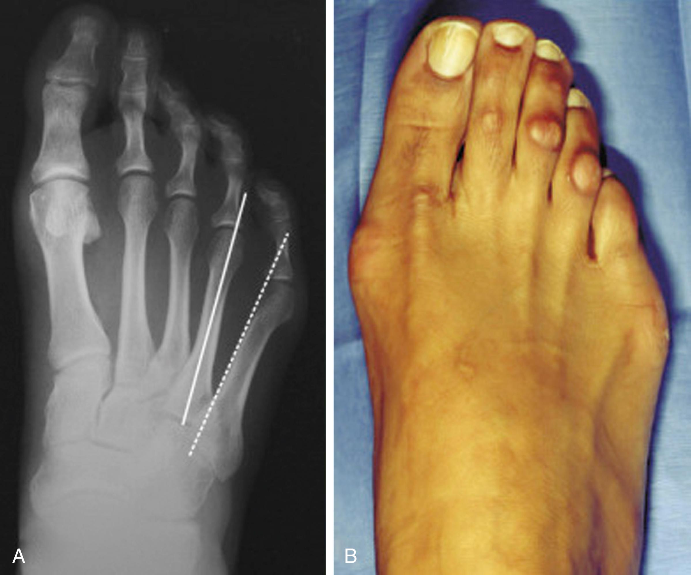 FIG. 194.1, (A) Bunionette, or Tailor’s bunion deformity, may be assessed radiographically with a lateral splaying in the distal fifth metatarsal. (B) Clinically, the patient generally presents with symptoms occurring laterally or plantar laterally, often with an adduction of the fifth toe.