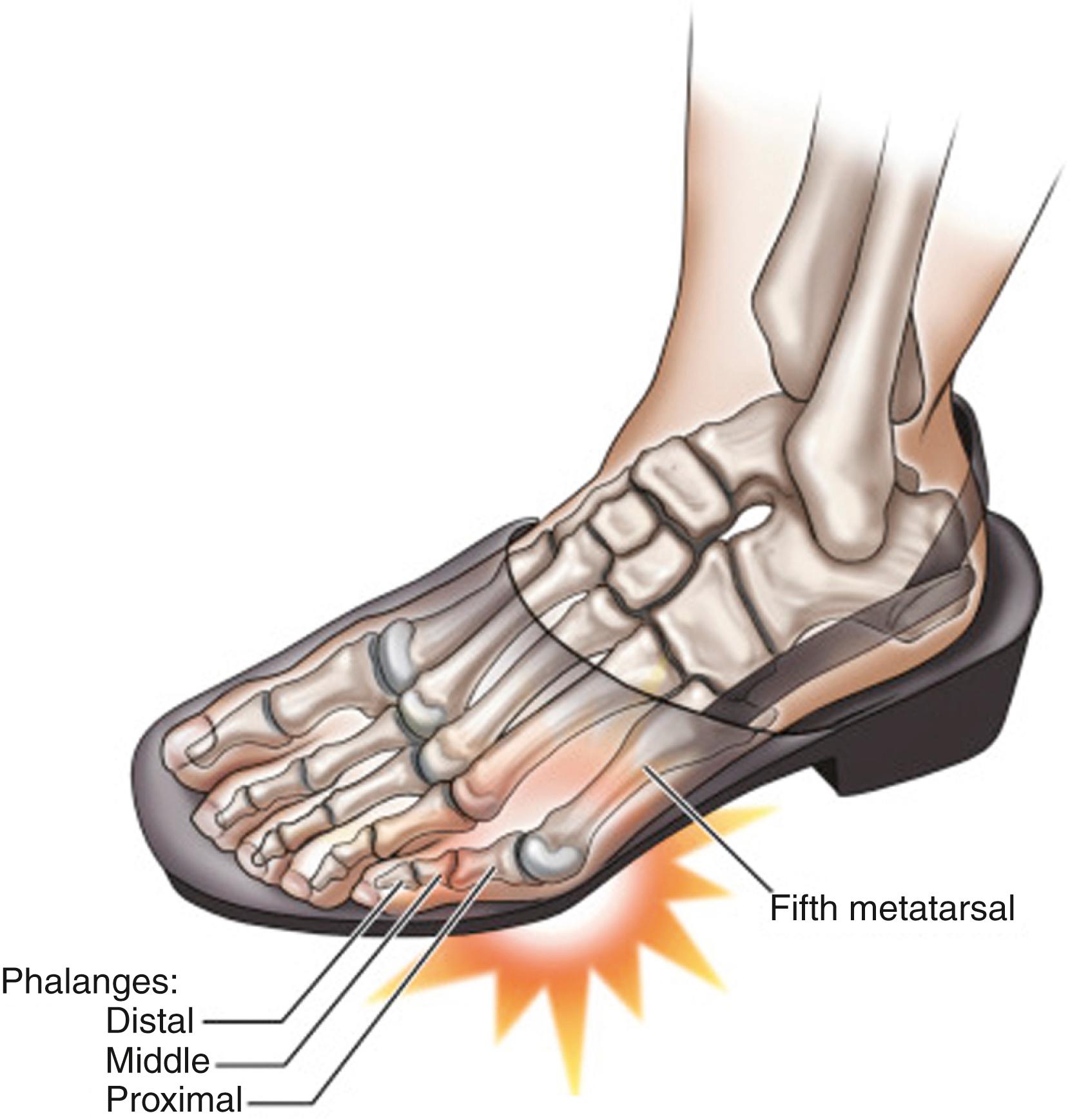 FIG. 194.2, The most common cause of bunionette formation is the wearing of tight, narrow-toed shoes.