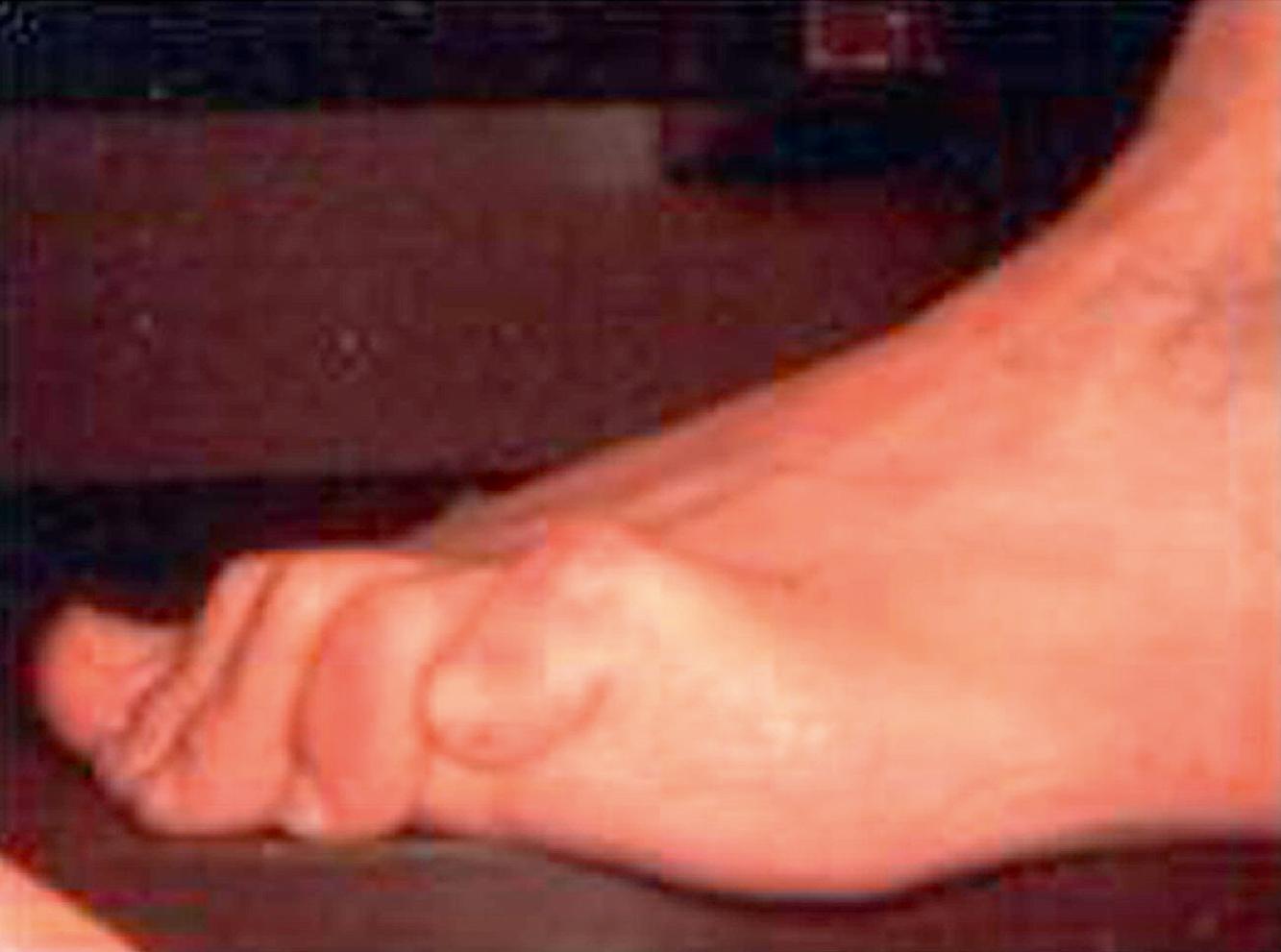 FIG. 196.1, Hammer toes. Note the flexion of the proximal interphalangeal joints.