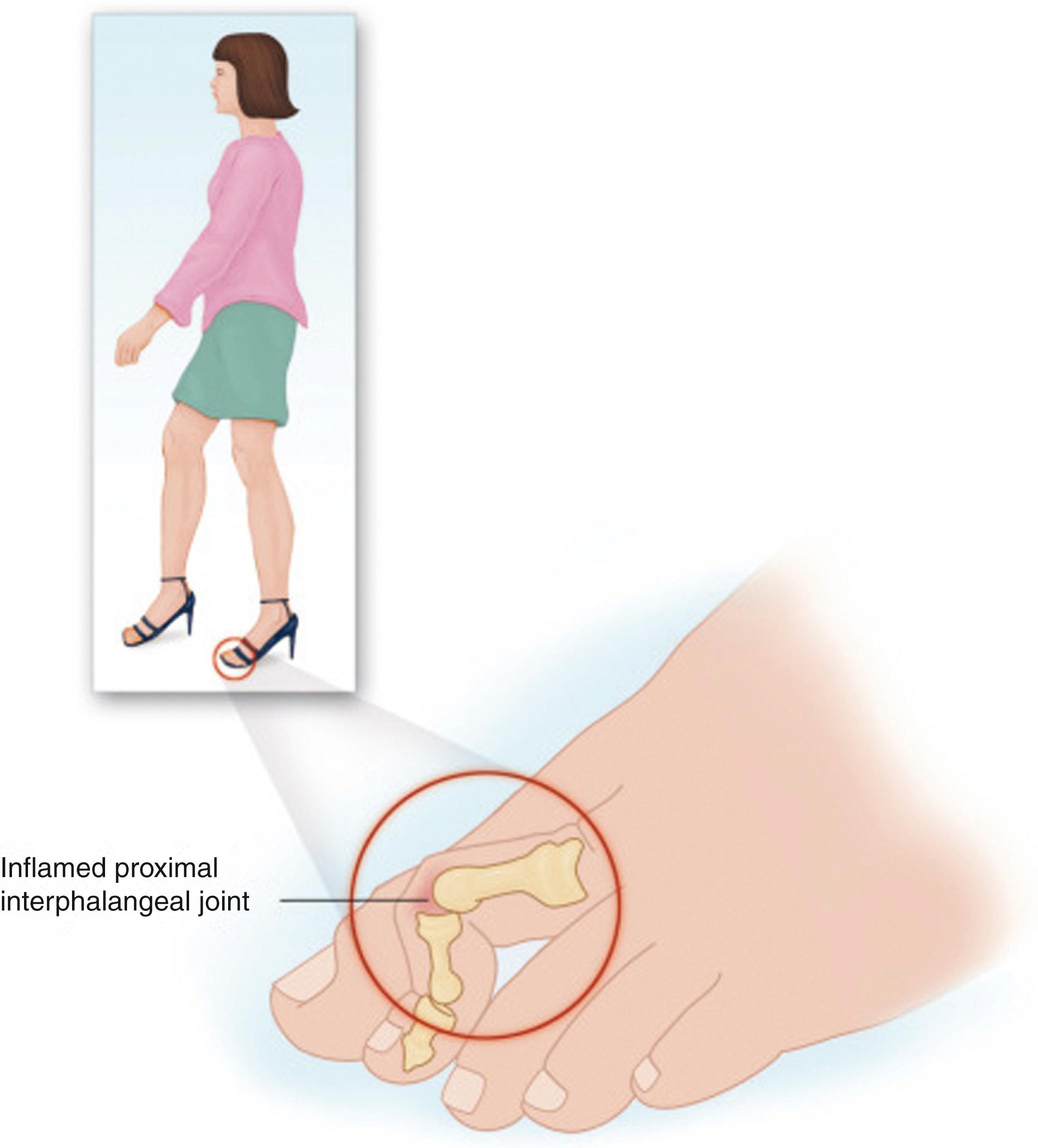 FIG. 196.2, Like hallux valgus deformity, hammer toe deformity usually is a result of wearing shoes that are too tight, although trauma also has been implicated. Wearing high-heeled shoes may exacerbate the problem.