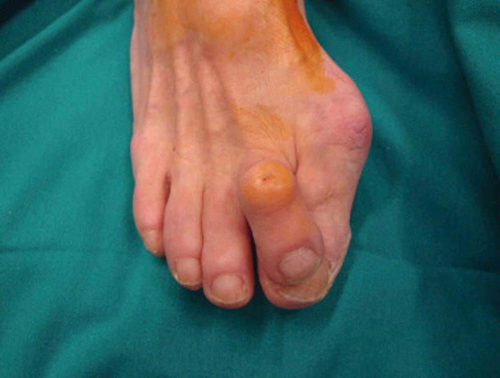 FIG. 196.3, Hammer toe deformity. Note adventitious bursa.