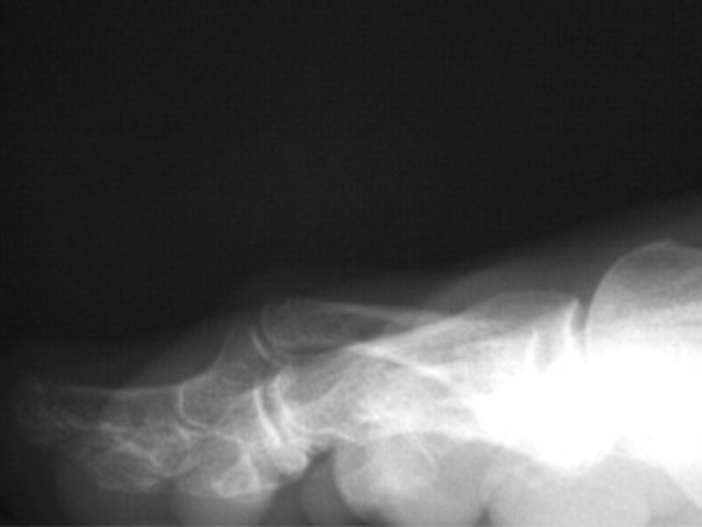 FIG. 196.4, Lateral x-ray view of hammer toe deformity.