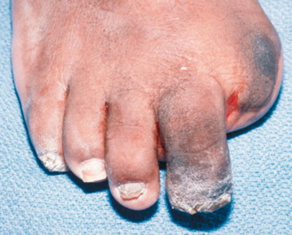 FIG. 195.5, Foot of a diabetic patient with osteomyelitis of the distal phalanx of an insensate second mallet toe (distal interphalangeal [DIP] joint contracture). Disarticulation at the DIP joint removed the infective focus and shortened the prominent toe. Previous metatarsophalangeal joint disarticulation of the great toe had exposed the second toe to distal trauma from a shoe.