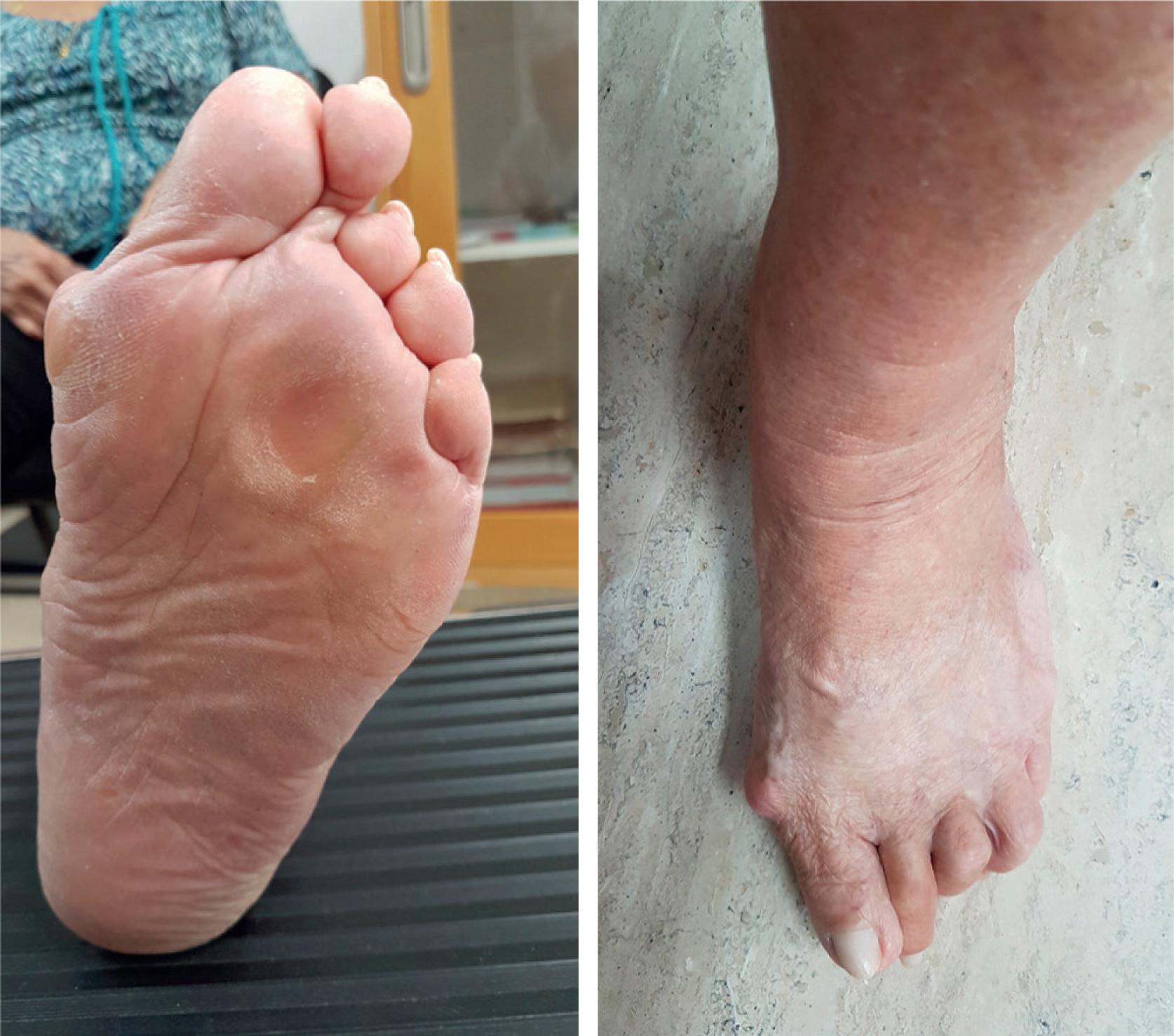 FIG. 200.1, Plantar keratosis over the metatarsal heads in a patient with metatarsalgia. Note the hallux valgus and hammer toe deformities.