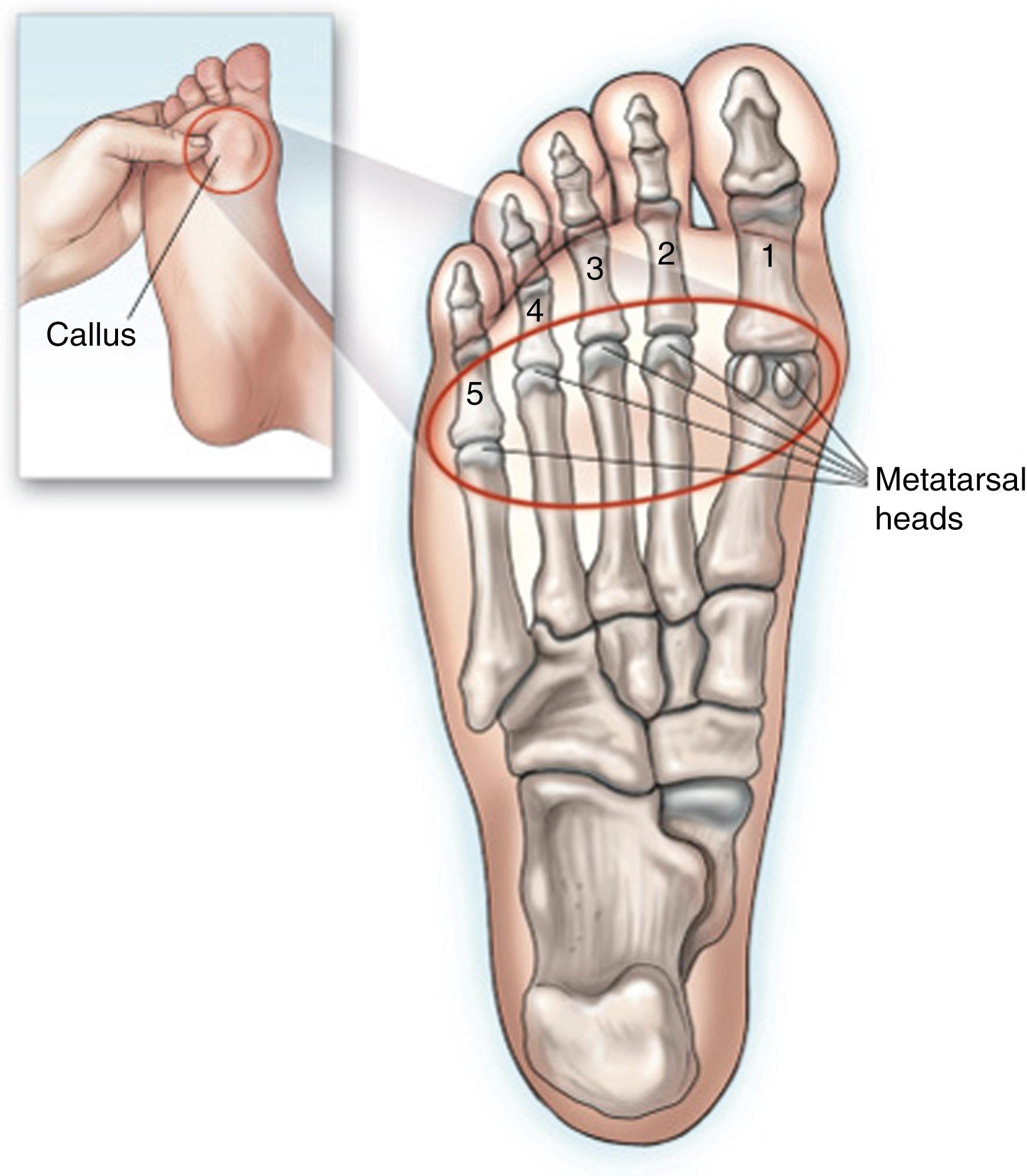 FIG. 200.2, On physical examination, pain can be reproduced by pressure on the metatarsal heads.