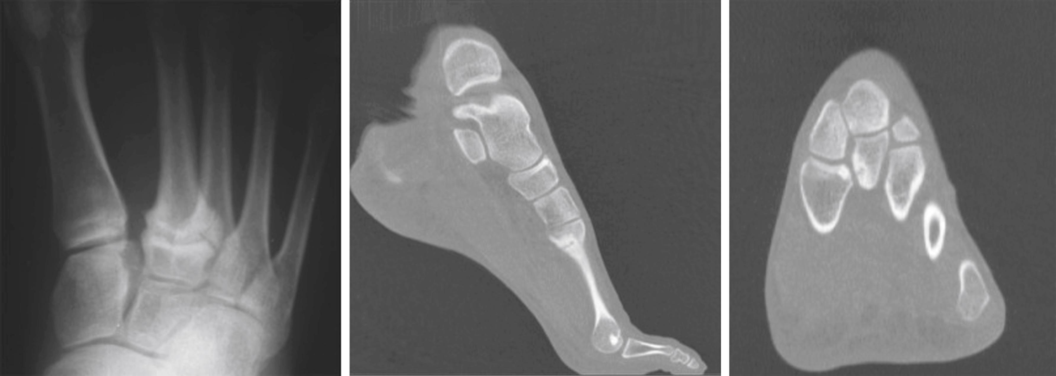 FIG. 200.3, Stress fracture of the base of the second metatarsal in dancers. Radiographic anterior-posterior view and computed tomography scan, sagittal and transverse plane views demonstrating the transverse fracture line.