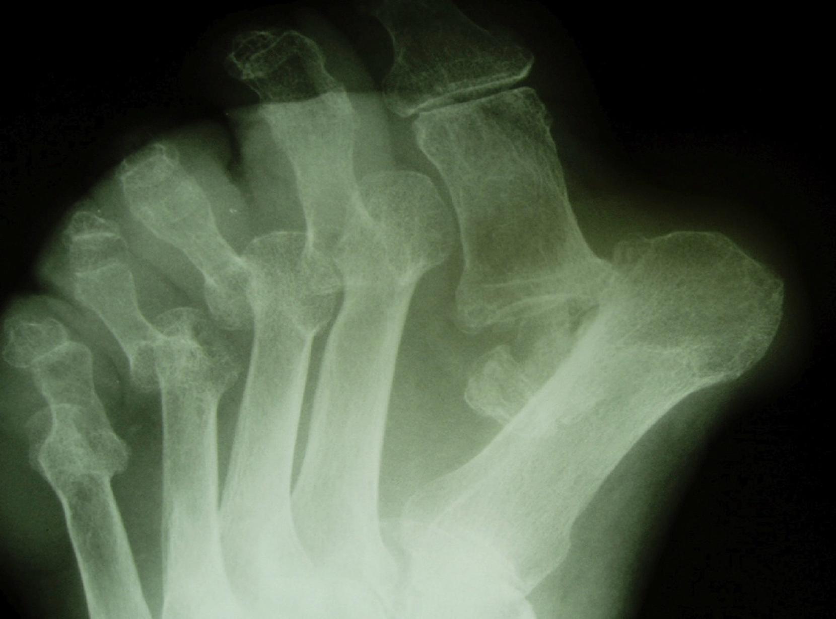 FIG. 200.4, A rheumatoid foot with associated severe deformities including dislocation of metatarsophalangeal joints, leading to metatarsalgia due to increased pressures.