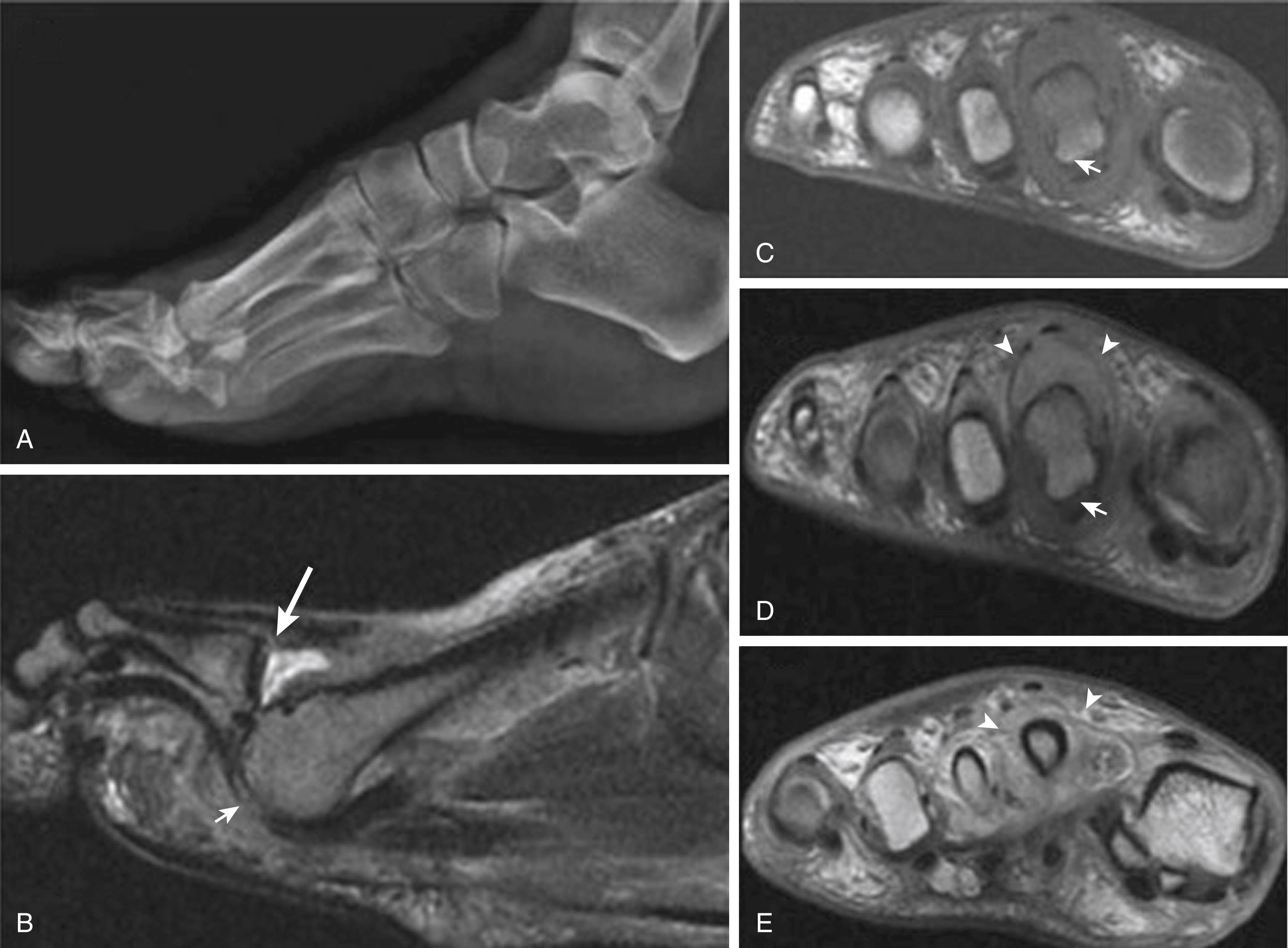 FIG. 200.5, Plantar plate degeneration of the second metatarsophalangeal joint with subsequent second metatarsal ray dislocation syndrome. Lateral x-ray of the foot (A) , sagittal T2-weighted fast spin (B) , short-axis T1-weighted images (C) of the forefoot; as well as postcontrast serial short-axis T1-weighted images (D and E) ; show nonvisualized plantar plate of the second MTP (short-thick arrow) because of its chronic degeneration with dorsal subluxation of the proximal phalanx, marked arthritic changes of the metatarsophalangeal joint (long arrow on B ) with small dorsal osteophyte, joint effusion, and edematous enhanced synovium as well as periarticular soft tissues (arrowheads in D and E ).