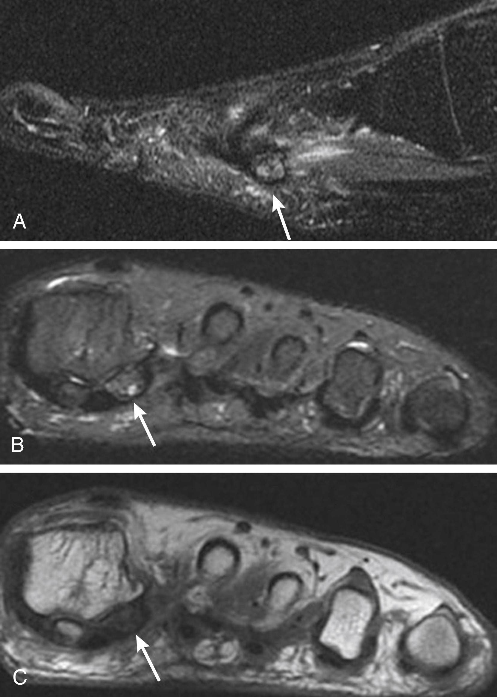 FIG. 200.6, Forefoot foreign-body granuloma. A 35-year-old agricultural worker presented with 1-month history of metatarsalgia with unclear traumatic history. Proton density fat-saturated short-axis images (A and B) and sagittal image (C) showed a thin signal-void structure that is linear on sagittal image and rounded on short-axis images. It is surrounded by hyperintense halo and hyperintense signal of the surrounding soft tissues of the plantar aspect of first inter-metatarsal space. A palm thorn was retrieved on surgical exploration.