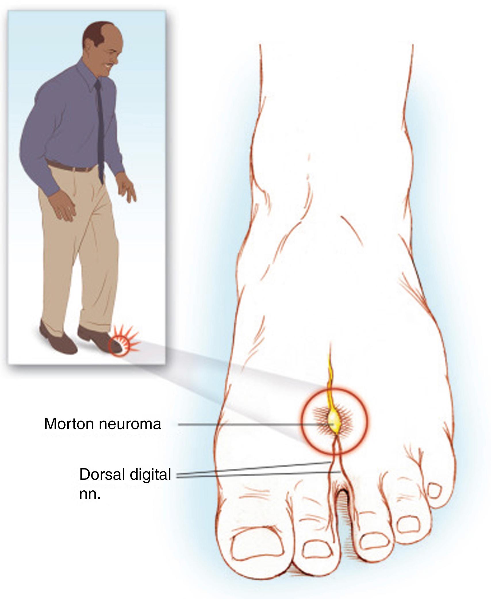 FIG. 197.1, The patient suffering from Morton neuroma often feels that he or she is walking with a stone in his or her shoe. The pain of Morton neuroma worsens with prolonged standing or walking for long distances and is exacerbated by improperly fitting or padded shoes.