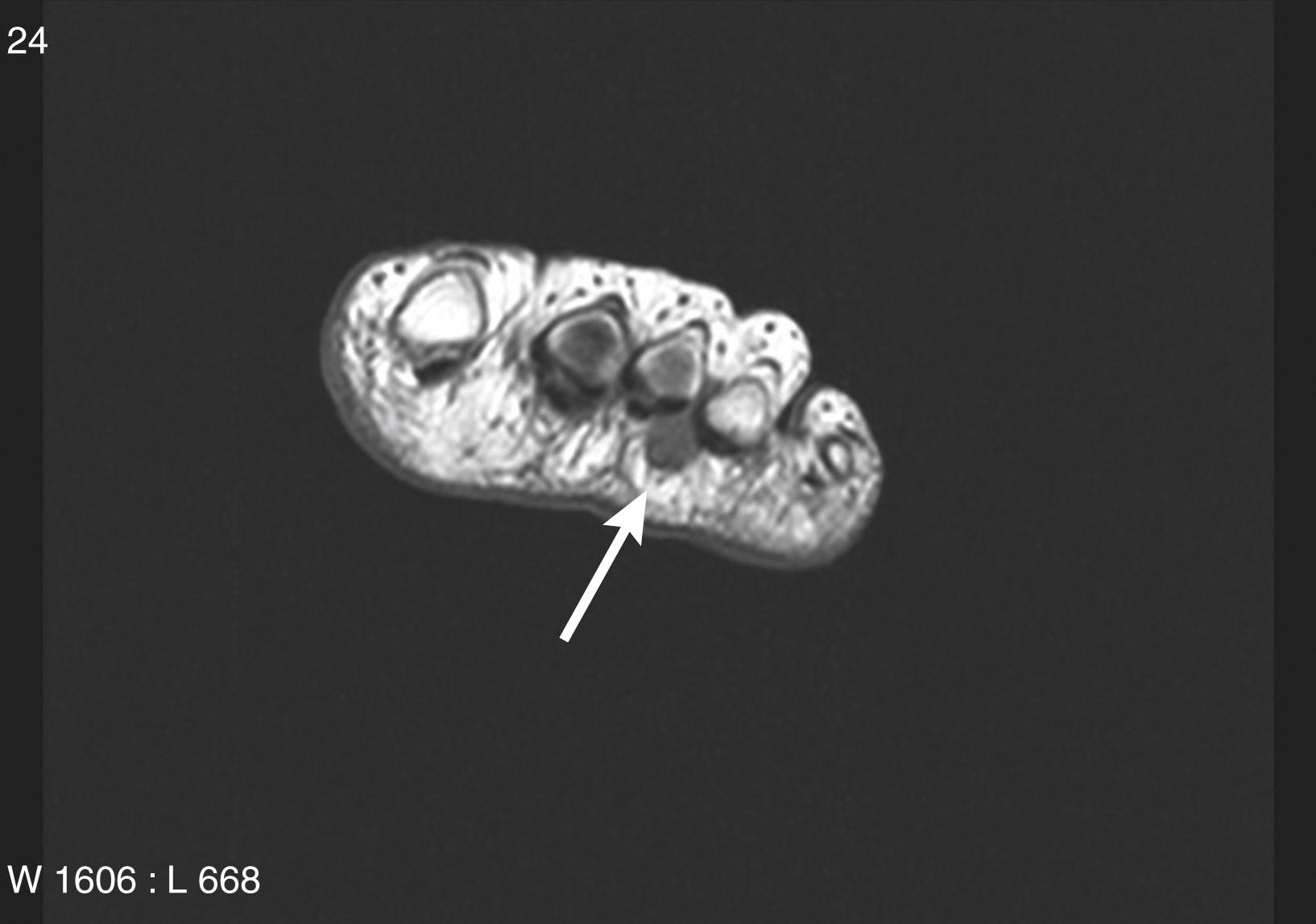 FIG. 197.2, Magnetic resonance imaging scan showing Morton neuroma (bold arrow) .