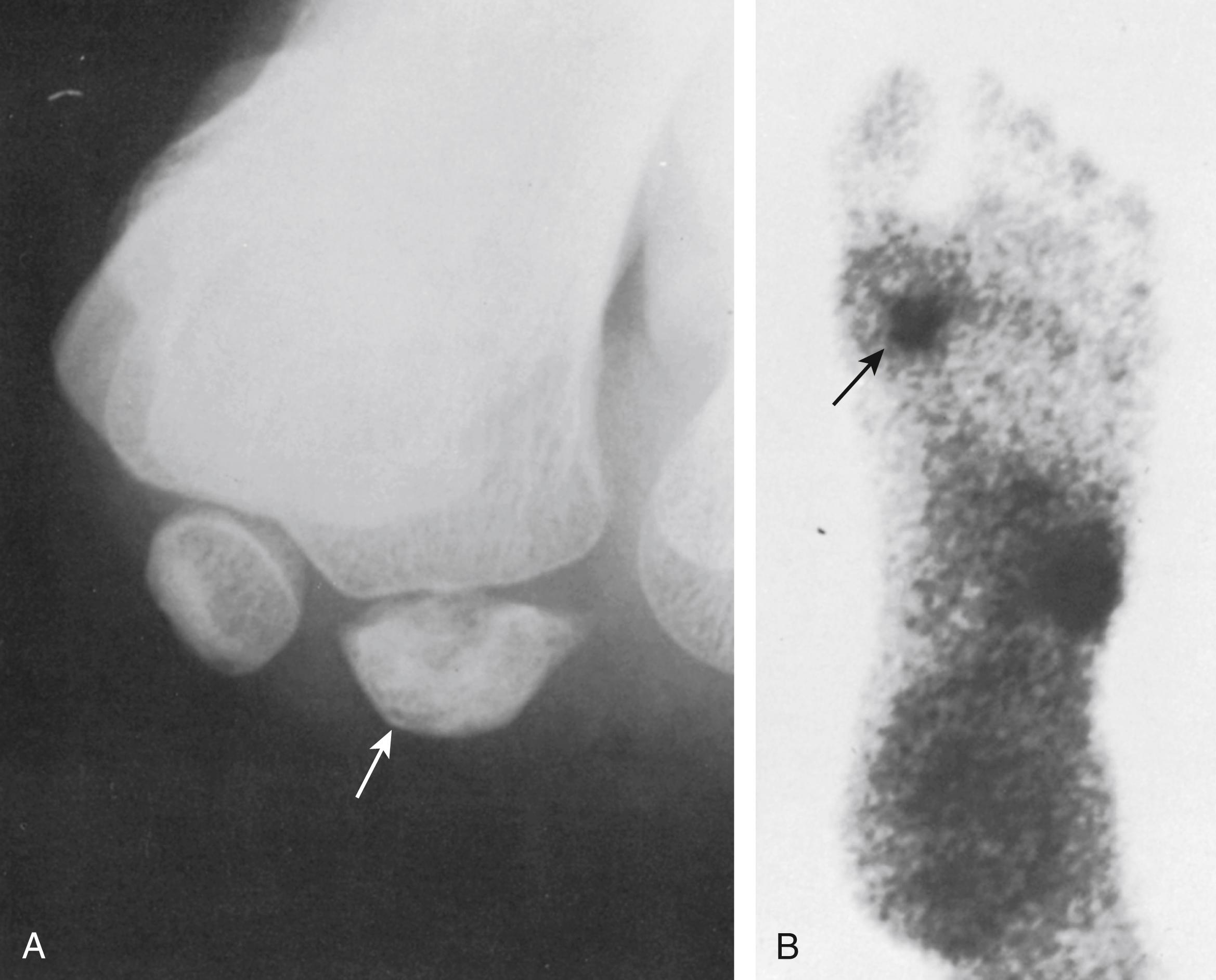 FIG. 199.2, Sesamoiditis. This 33-year-old man had pain and swelling beneath the great toe, with no history of recent injury. A, Radiograph shows irregularity and flattening of the lateral sesamoid bone (arrow) beneath the first metatarsal head. B, Bone scan documents increased accumulation of the radionuclide (arrow) in this region, as well as laterally in the midfoot.