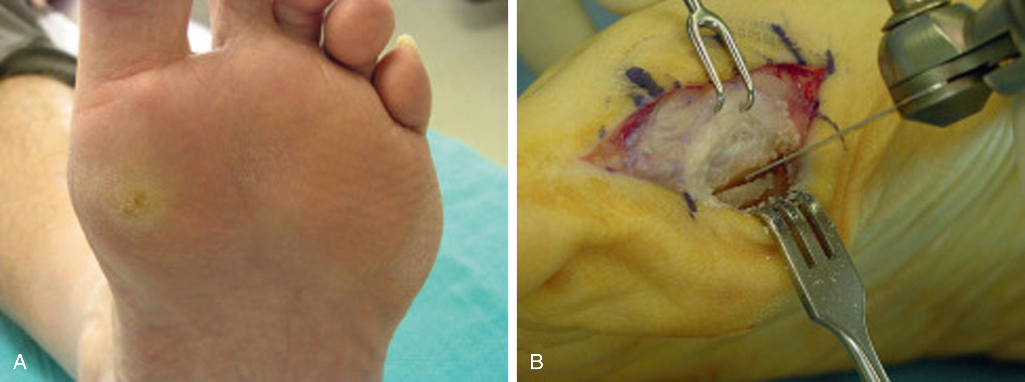 FIG. 199.3, A, Clinical photograph of intractable plantar keratosis from tibial sesamoid. B, Operative photograph demonstrating technique of sesamoid shaving. A saw is used to resect a portion of prominent sesamoid plantar surface.