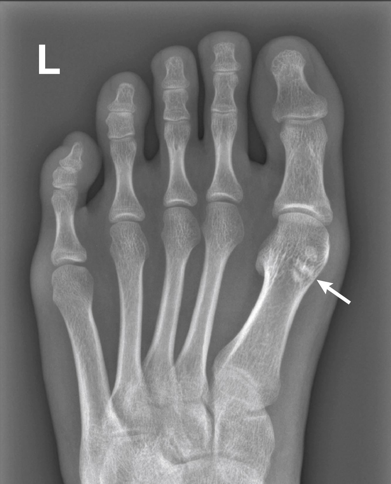 FIG. 199.4, Initial frontal left foot radiograph showing a tripartite appearance of the medial hallux sesamoid (white arrow) . No significant overlying soft-tissue swelling was appreciated. Note is also made of periarticular osteopenia in the metatarsophalangeal and interphalangeal joints. The clinical diagnosis of sesamoiditis was made.