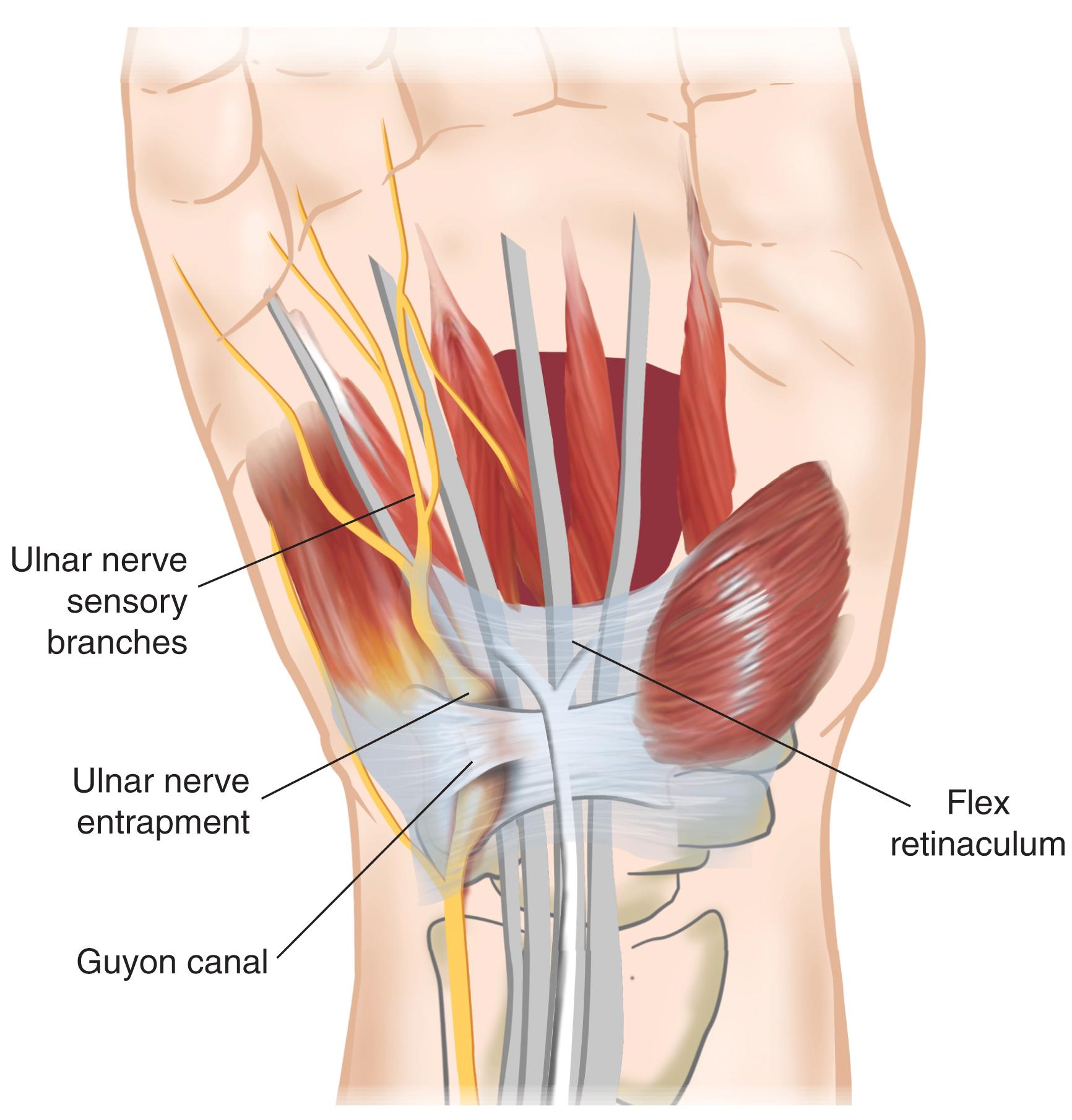 FIG. 94.1, Ulnar tunnel syndrome is caused by entrapment of the ulnar nerve as it passes through the ulnar tunnel, which is also known as the Guyon canal.