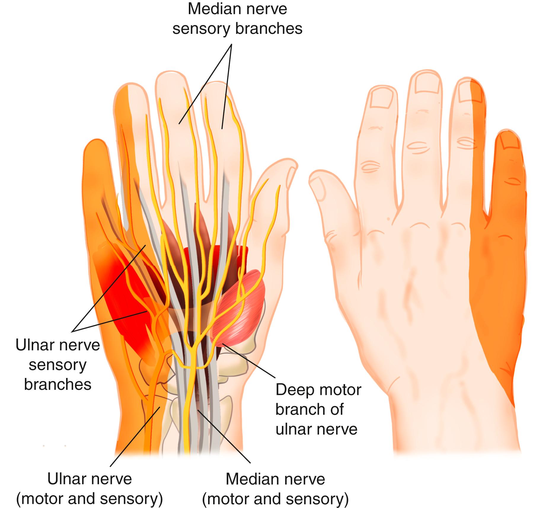 FIG. 94.2, Ulnar tunnel syndrome can present differently depending on what portions of the ulnar nerve are compromised as they pass through the ulnar tunnel.