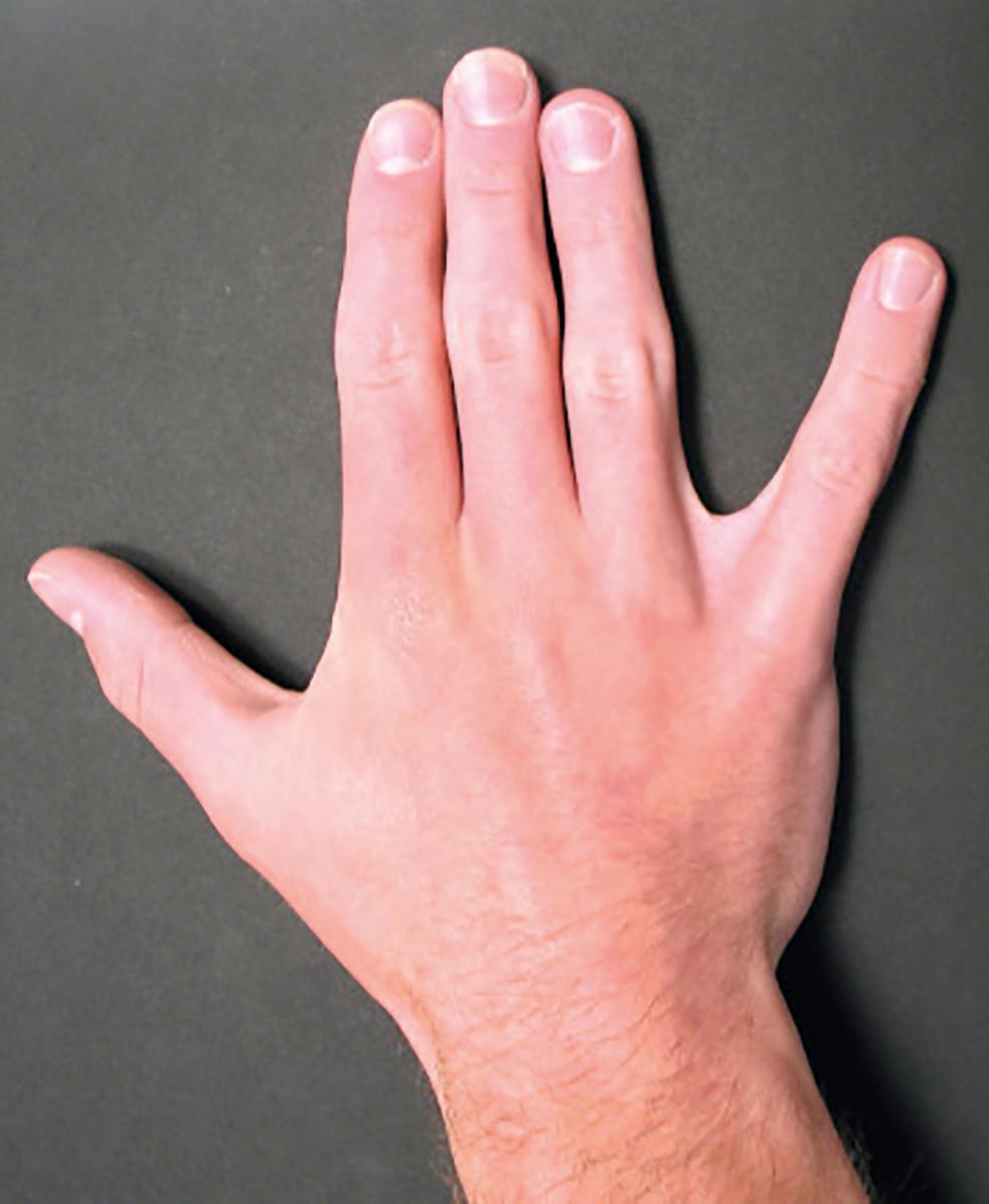 FIG. 94.3, A positive spread sign test is highly suggestive of the diagnosis of ulnar tunnel syndrome. The spread sign test is performed by having the patient relax the hand on the examination table and then spread his or her fingers as far apart as possible. The sign is considered positive if the patient is unable to spread two or more fingers apart.