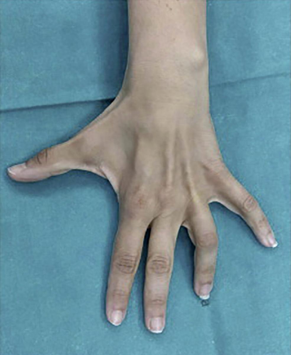 FIG. 94.4, Wasting of the interosseous muscles of the hand.