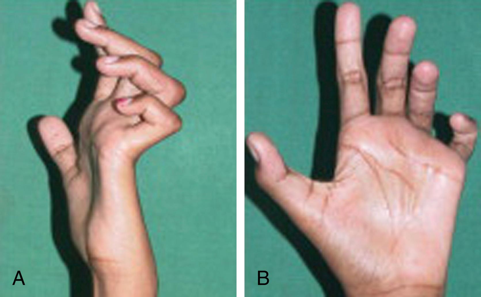 FIG. 94.5, Claw hand deformity .