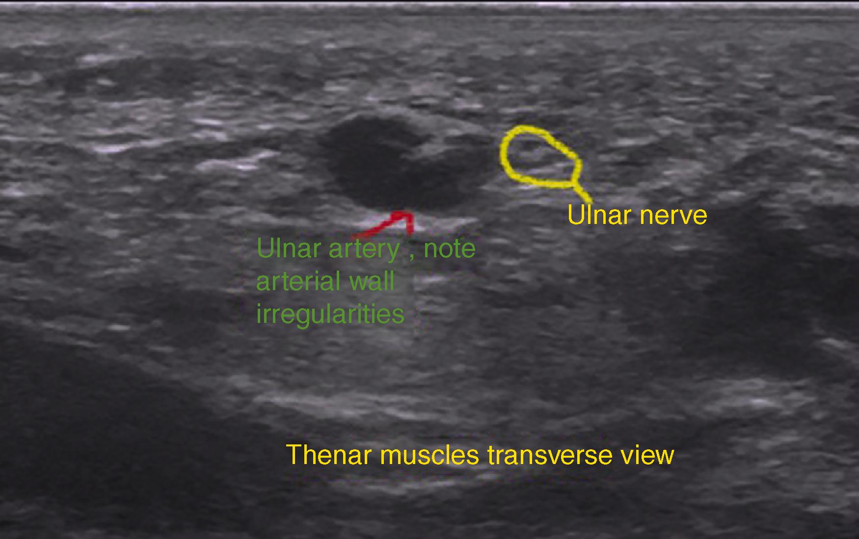 FIG. 94.6, Transverse ultrasound image demonstrating abnormalities of the ulnar artery in a patient presenting with hammer hamate syndrome.