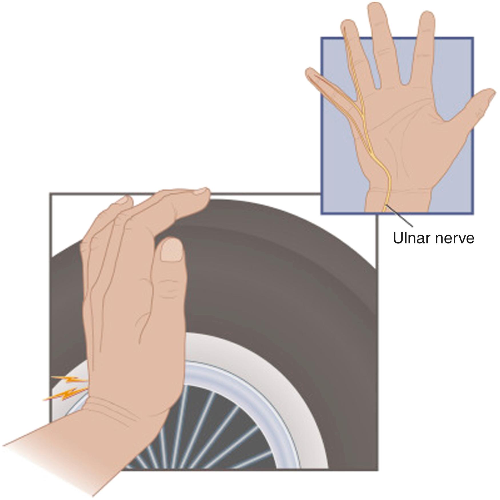 FIG. 94.7, Because the ulnar artery is protected by only skin, subcutaneous tissue, the superficial aponeurosis, and the tiny palmaris brevis muscle, the lid or hubcap acts as a “hammer” smashing the superficial palmar branch of the ulnar artery against the hook of the hamate bone, which serves as the “anvil.” This injury to the ulnar artery is known as the hammer hamate syndrome.