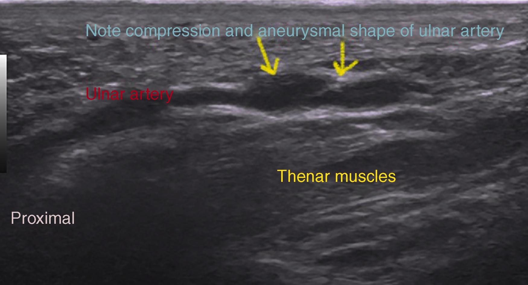 FIG. 94.8, Longitudinal ultrasound image of the ulnar artery demonstrating aneurysmal dilatation in a patient who used his hand to hammer on a hub cap.