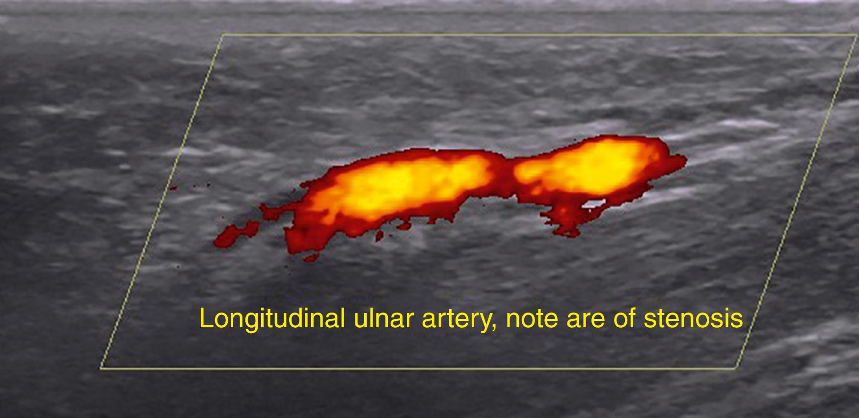 FIG. 94.9, Longitudinal color Doppler image demonstrating stenosis of the distal ulnar artery in a patient suffering from hammer hamate syndrome.