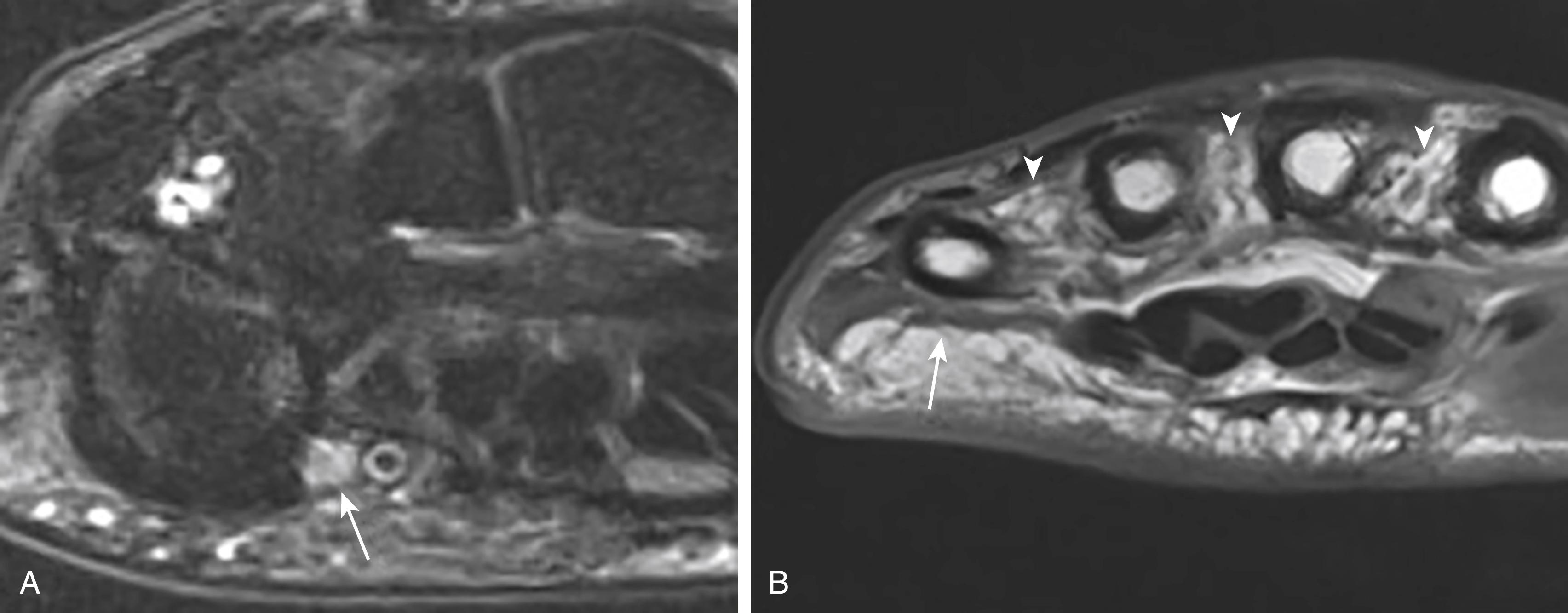 FIG. 94.10, Ulnar neuropathy secondary to trauma to the wrist. A, Axial short inversion time inversion recovery of the wrist shows edema of the ulnar nerve in the Guyon canal (arrow) . B, Axial T1 of the hand shows atrophy of the hypothenar muscles (white arrow) and the interossei muscles (arrowheads) secondary to long-standing ulnar neuropathy.