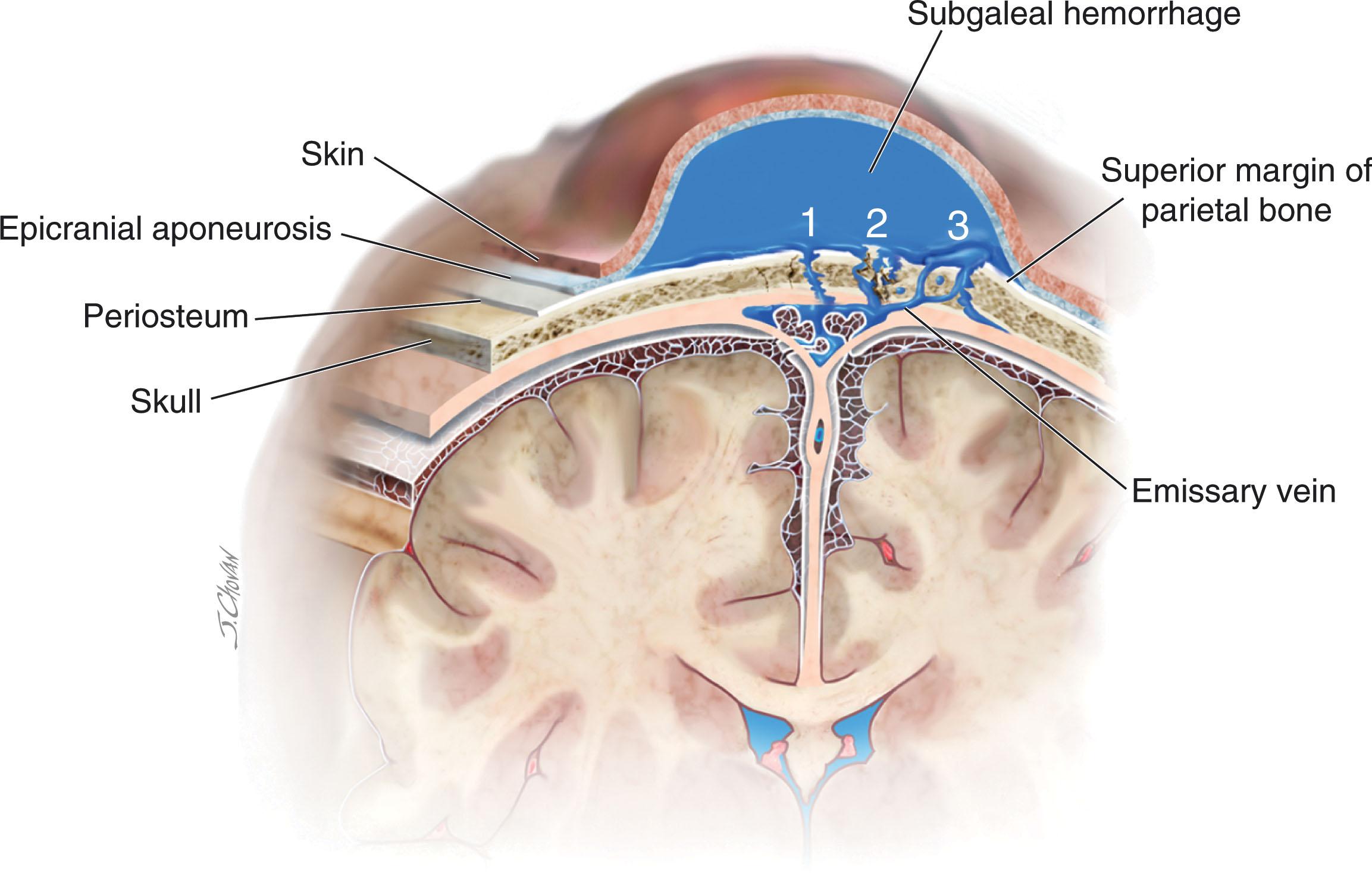 Fig. 40.2, Schematic drawing of the potential events that lead to subgaleal hemorrhage: 1 , suture diastasis, 2 , skull fracture, and 3 , fragmentation of the superior margin of the parietal bone with ruptured emissary vein.