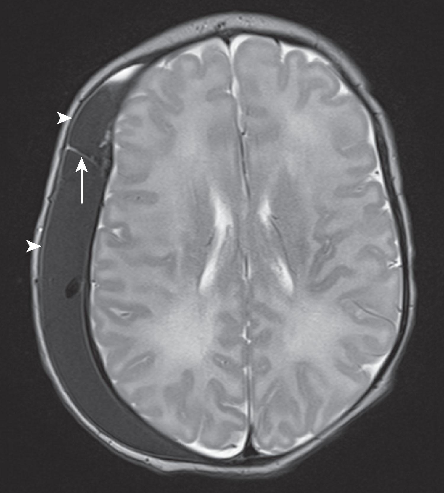 Fig. 40.4, Frontal and parietal cephalhematomas: MRI scan in a 1-day-old infant delivered by vacuum extraction. Clinical diagnosis was subgaleal hemorrhage, because the scalp mass crossed the coronal suture line. However, MRI scan shows separate frontal and parietal cephalhematomas. The arrowheads indicate the periosteum external to the (subperiosteal) hematoma. The arrow indicates stripped periosteum at the coronal suture, leading to the external clinical appearance suggestive of a subgaleal hematoma. The intracerebral structures are normal.