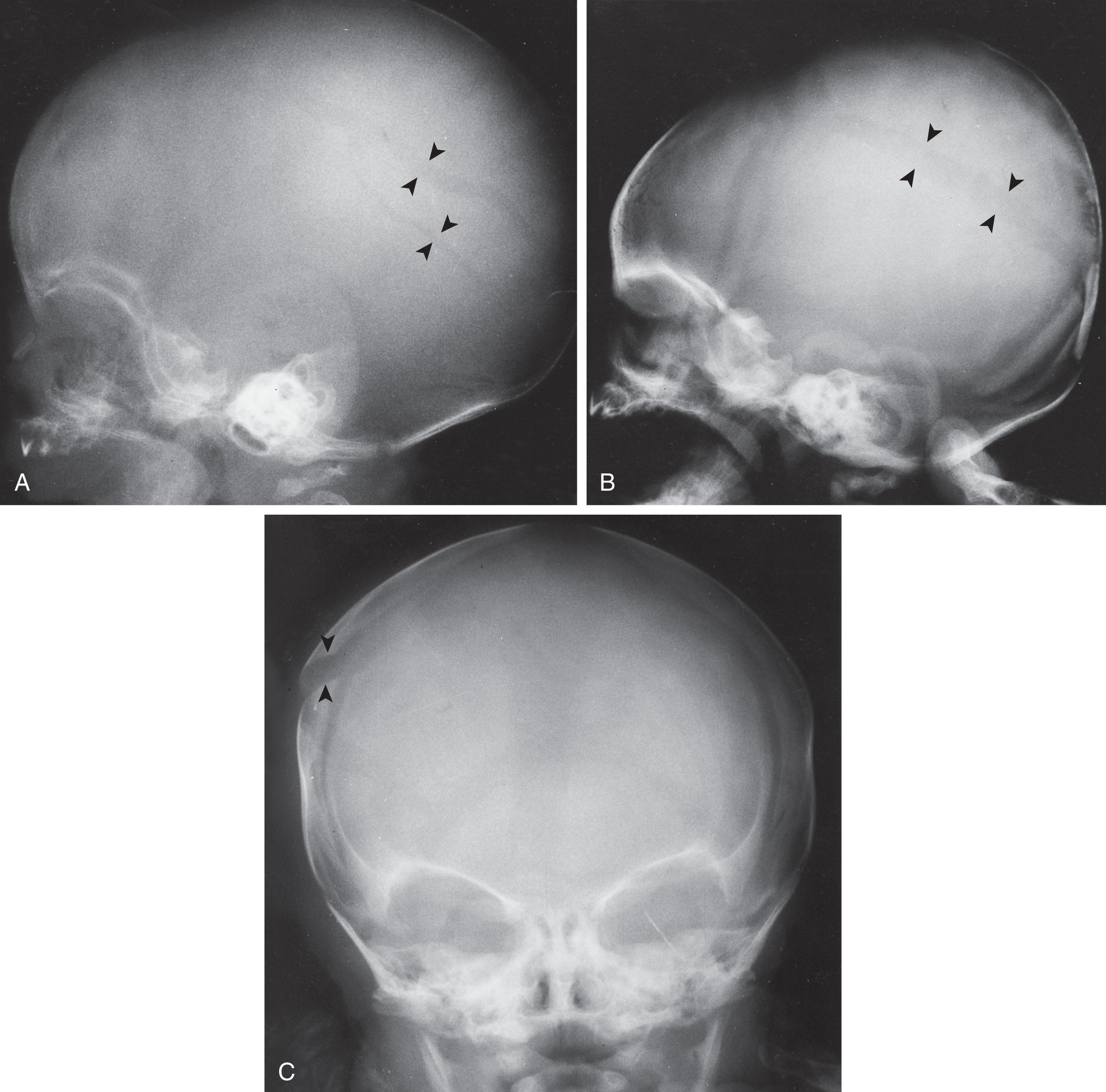 Fig. 40.5, Linear skull fractures in newborn x-rays. (A, B, and C) Lesions are identified by arrowheads .